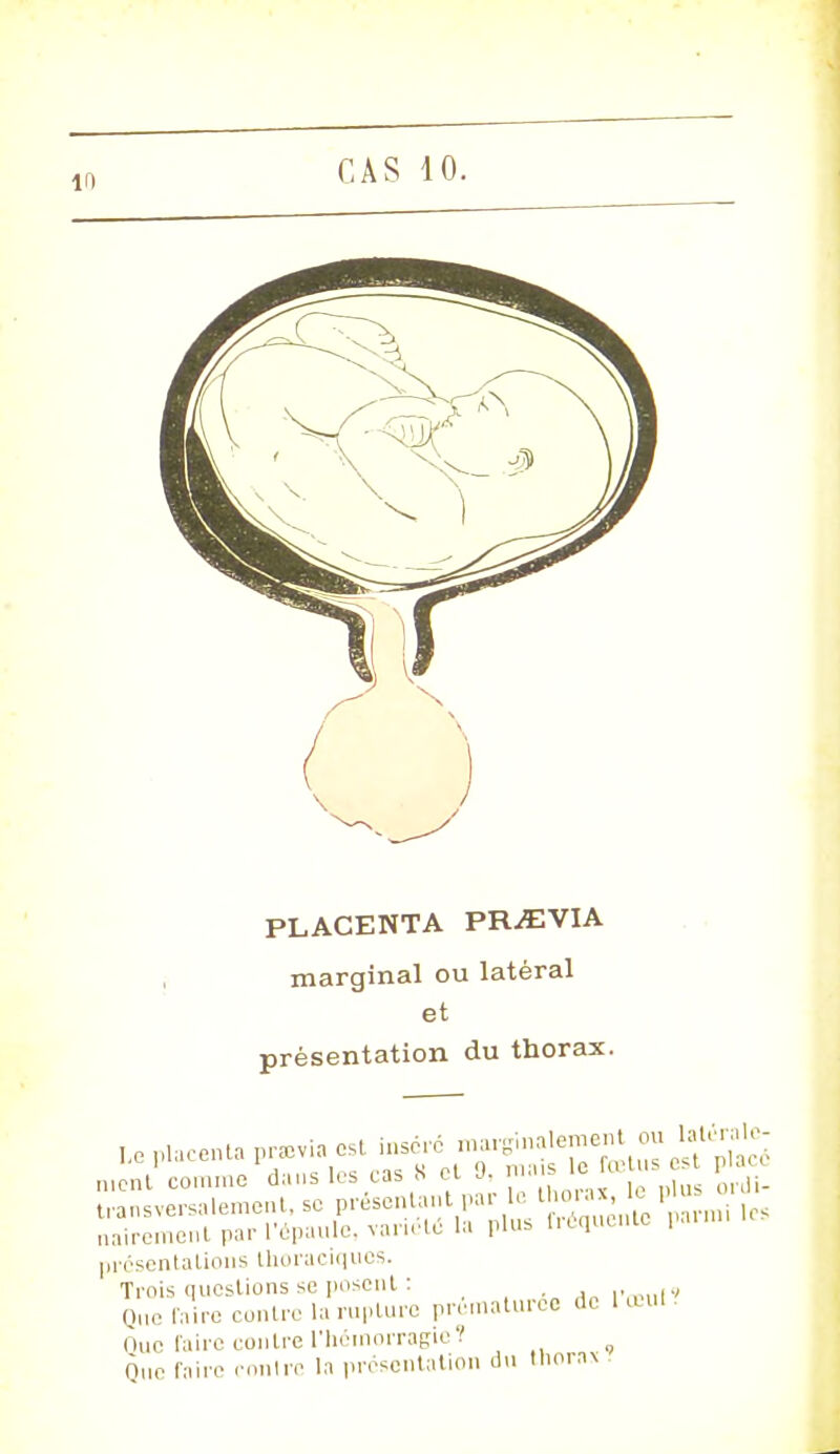 PLACENTA PRiEVIA marginal ou latéral et présentation du thorax. ment comme dans les cas « et J, 1, , ordi. transversalement, se présentant pa,lo t horas, le plu» ^ nairement par l'épaule, variété la plus liequenu. i pvésentalions Llioraciques. Trois questions se posent : Que foiro contre la rupture prématurée de 1 ODUl Que faire contre l'hémorragie? Que taire contre la présentation du tnorn% .