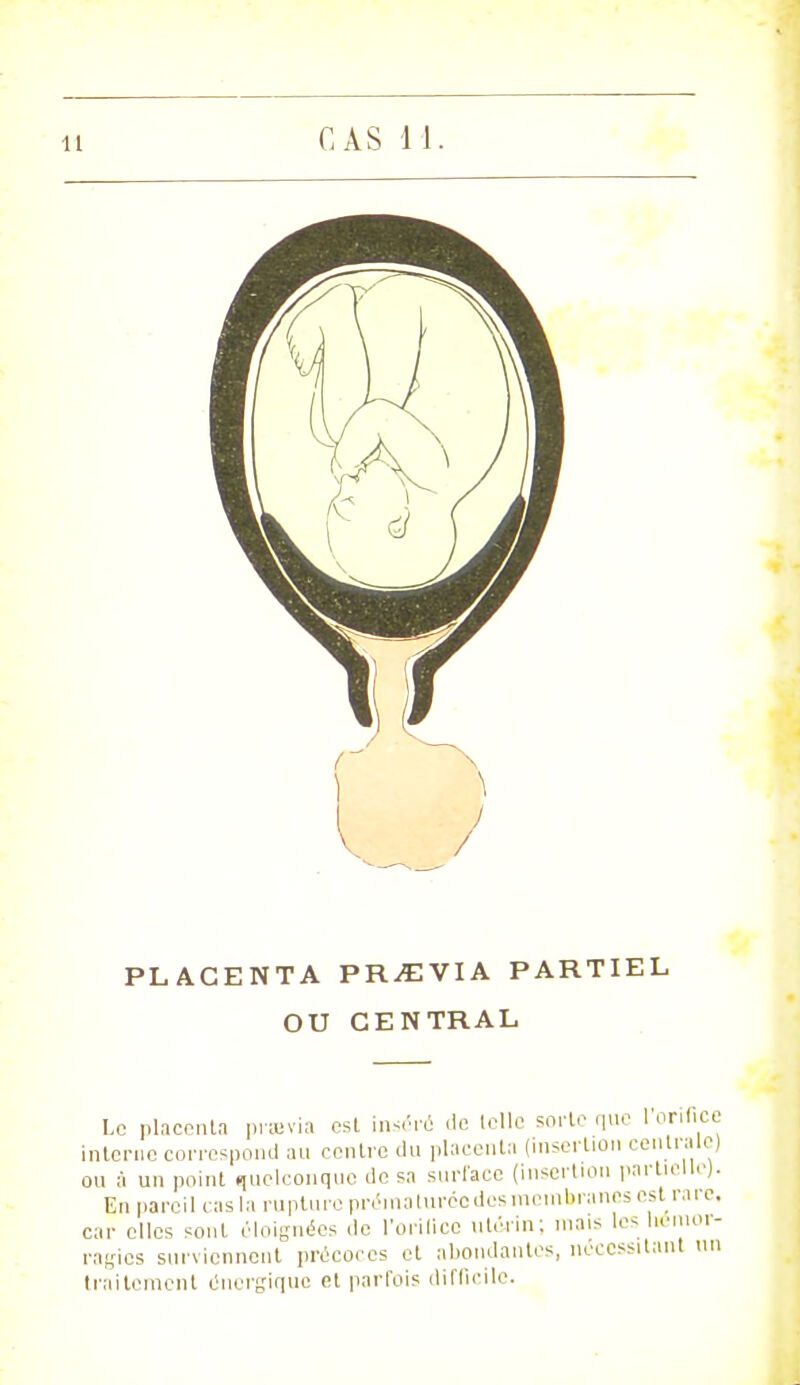 PLACENTA PR/EVIA PARTIEL OU CENTRAL Le placenta prasvia est inséré de telle sorte que 1 orifice interne correspond au centre du placenta (insertion centrale) ou à un point quelconque de sa surface (insertion partielle). En pareil cas la rupture prématurée des membranes est rare, car elles sont éloignées de l'orifice utérin; mais les hémor- ragies surviennent précoces et abondantes, nécessitant un traitement énergique et parfois difficile.