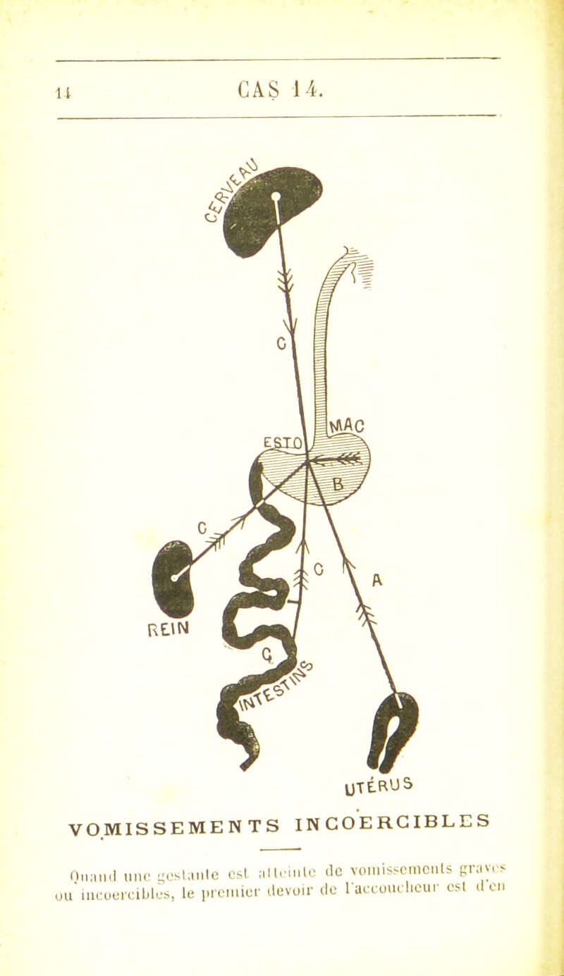 UTÉ.RUS VOMISSEMENTS INCOERCIBLES Quand une gostanle est allciule de vomissements gray i incoercibles, le premier devoir de l'accoucheur esl d,