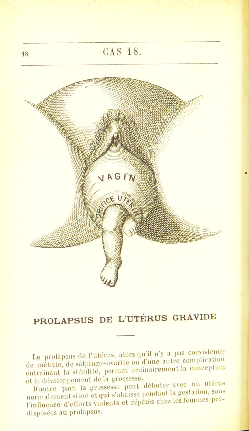 PROLAPSUS DE L'UTÉRUS GRAVIDE Le prolapsus de l'utérus, alors qu'il n'y a pas coexistence de méùSerdesalpingo-ovariteou d'une autr.oomphe., entraînant la stérilité, permet ordinairement la conception et le développement do la grossesse. D'autre part la grossesse peut débuter avec un utuu normalement situé et qui s'abaisse pendanl la gesa on, sou l'influence d'efforts violents et répètes chez lesferames pu disposées au prolapsus.