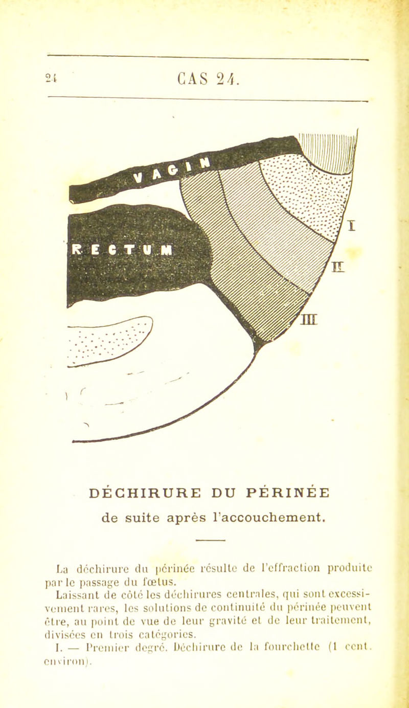 DÉCHIRURE DU PÉRINÉE de suite après l'accouchement. La déchirure du périnée résulte de l'effraction produite parle passage du fœtus. Laissant de coté les déchirures centrales, qui sont excessi- vement rares, les suintions de continuité du périnée peuvent être, au point de vue de leur gravité et de leur traitement, divisées en trois catégories. I.— Premier degré. Déchirure de la fourchetle (1 cent, cm i ion i.