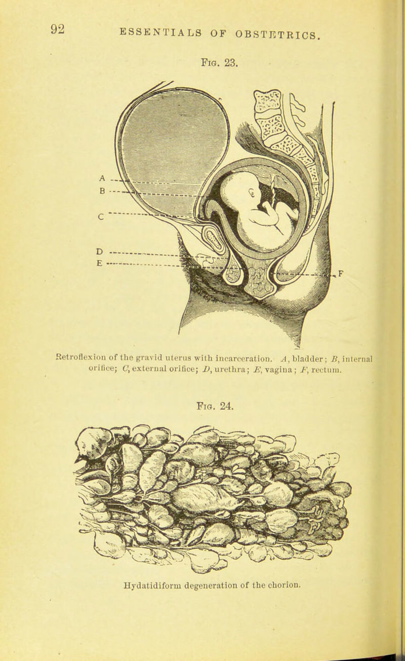 Fig. 23. Hydatidiform degeneration of the chorion.