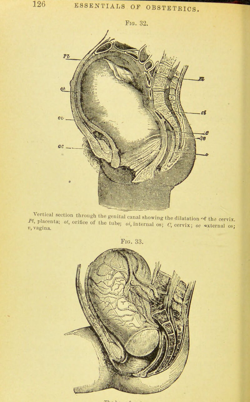 Fig. 32. Vertical se, tio„ through the genital canal showing the dilatation ~f the cervix placenta; at, orifice of the tube; oi, interna, os; C, cervix; oc Fig. 33. mi. _ v