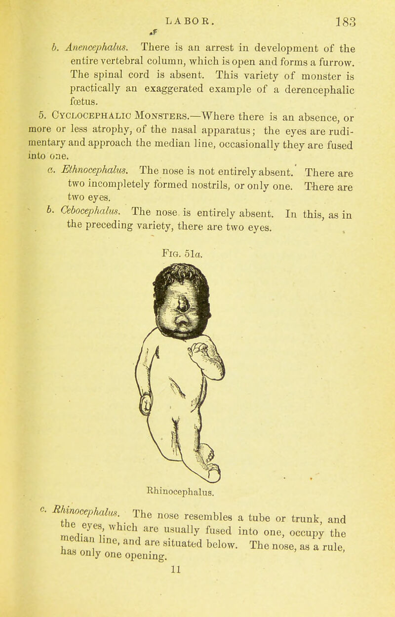 i§ b. Anencephalus. There is an arrest in development of the entire vertebral column, which is open and forms a furrow. The spinal cord is absent. This variety of monster is practically an exaggerated example of a derencephalic foetus. 5. Cyclocephalic Monsters.—Where there is an absence, or more or less atrophy, of the nasal apparatus; the eyes are rudi- mentary and approach the median line, occasionally they are fused into one. a. Ethnocephalm. The nose is not entirely absent.' There are two incompletely formed nostrils, or only one. There are two eyes. b. Cebocephalus. The nose is entirely absent. In this, as in the preceding variety, there are two eyes. Fig. 51a. Rhinocephalus. The nose resembles a tube or trunk, and the: eyes, which are usually fused into one, occupy the median line, and are situated below. The nose, as a rule, nas only one opening. 11
