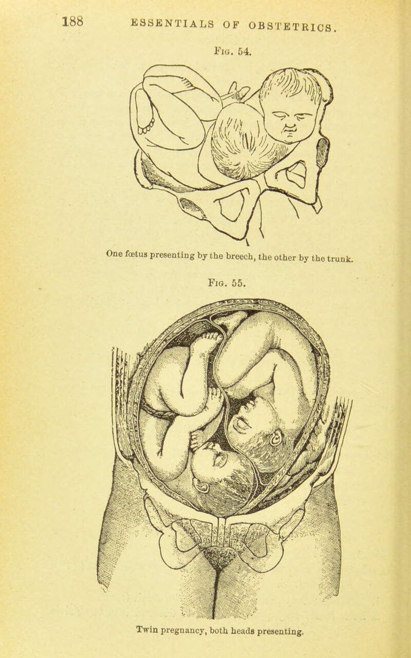 Fig. 54. Twin pregnancy, both heads presenting.