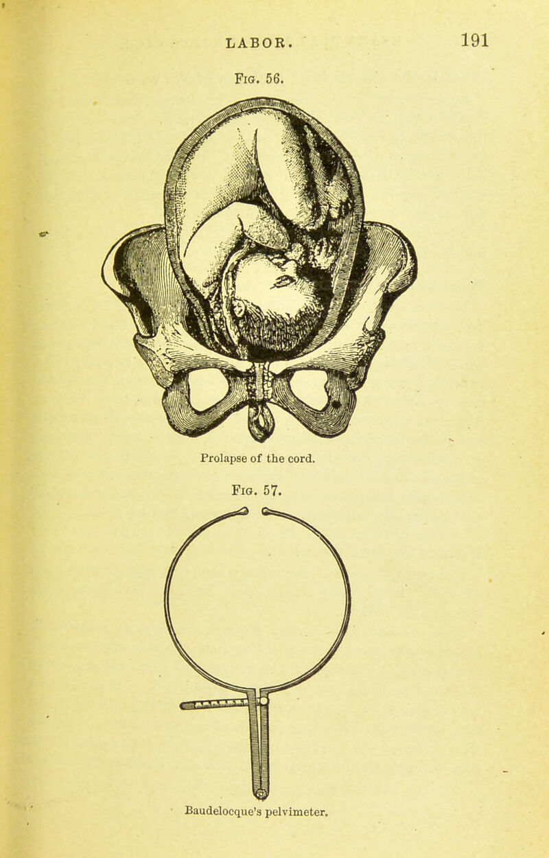 Fig. 56. Prolapse of the cord. Fig. 57. Baudelocque'a pelvimeter.
