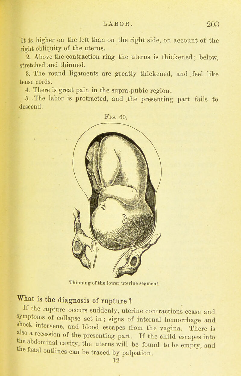 It is higher on the left than on the right side, on account of the right obliquity of the uterus. 2. Above the contraction ring the uterus is thickened; below, stretched and thinned. 3. The round ligaments are greatly thickened, and.feel like tense cords. 4. There is great pain in the supra-pubic region. 5. The labor is protracted, and .the presenting part fails to descend. Fig Thinning of the lower uterine segment. What is the diagnosis of rupture ? If the rupture occurs suddenly, uterine contractions cease and symptoms of collapse set in; signs of internal hemorrhage and shock intervene, and blood escapes from the vagina. There is also a recession of the presenting part. If the child escapes into ihe abdominal cavity, the uterus will be found to be empty, and t&e foetal outlines can be traced by palpation. 12