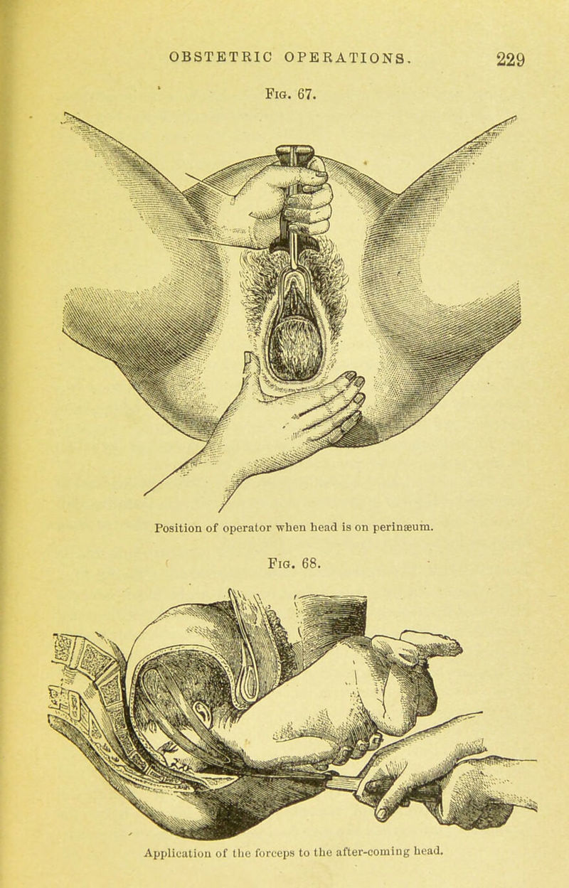 Position of operator when head is on perinseum. Fig. 68. Application of the forceps to the after-coming head.