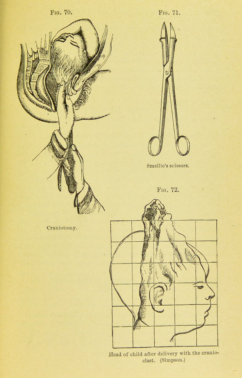 Fig. 71. Smell ie's scissors. Fig. 72. V S: f \ pi -fi Head of child after delivery with the cranio- clast. (Simpson.)