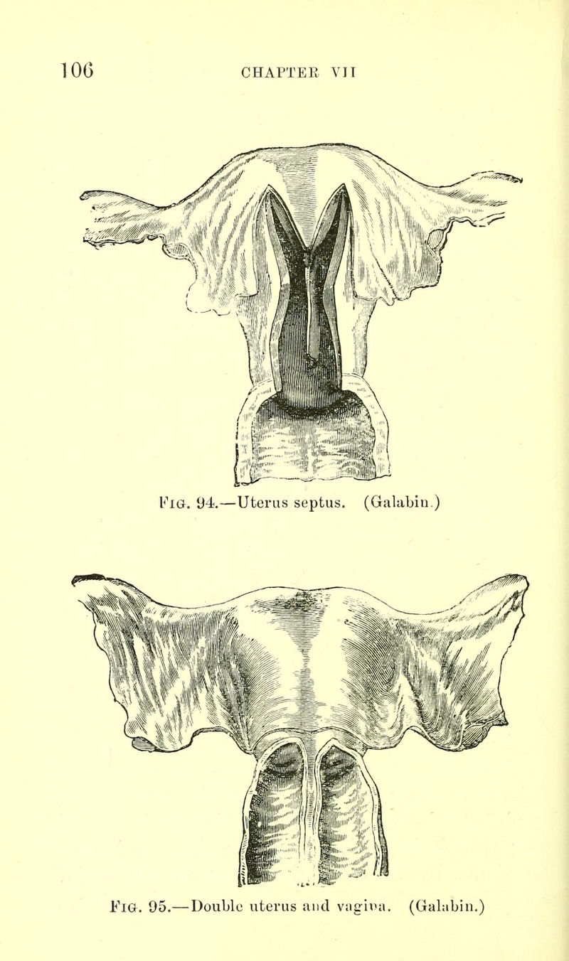 Fia. 95.—Double uterus and viigii>a. (Galabin.)