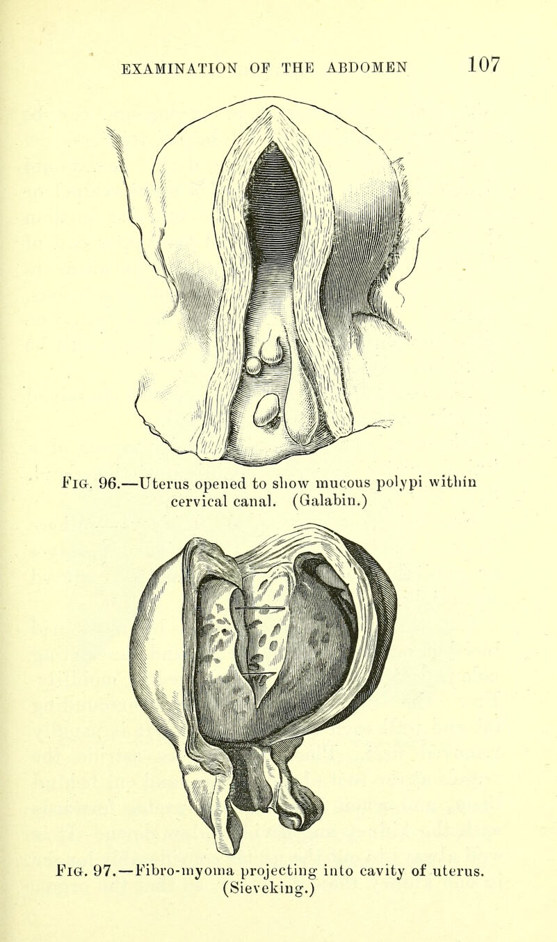 Fig. 97. — Fibro-inyoma projecting into cavity of uterus. (Sievekiug.)