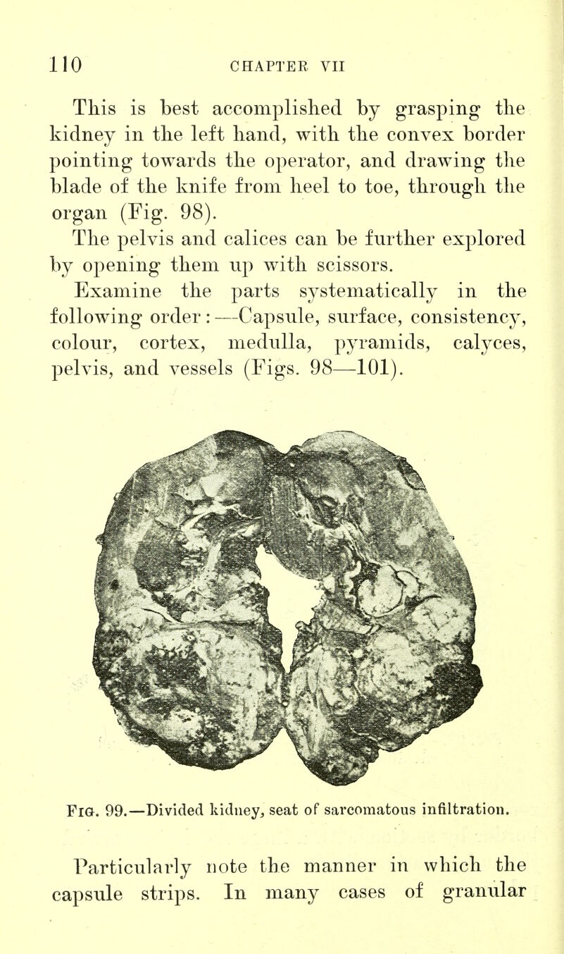 This is best accomplished by grasping the kidney in the left hand, with the convex border pointing towards the operator, and drawing the blade of the knife from heel to toe, through the organ (Fig. 98). The pelvis and calices can be further explored by opening them up with scissors. Examine the parts systematically in the following order : —Capsule, surface, consistency, colour, cortex, medulla, pyramids, calyces, pelvis, and vessels (Figs. 98—101). Fig. 99.—Divided kidney, seat of sarcomatous infiltration. Particularly note the manner in which the capsule strips. In many cases of granular