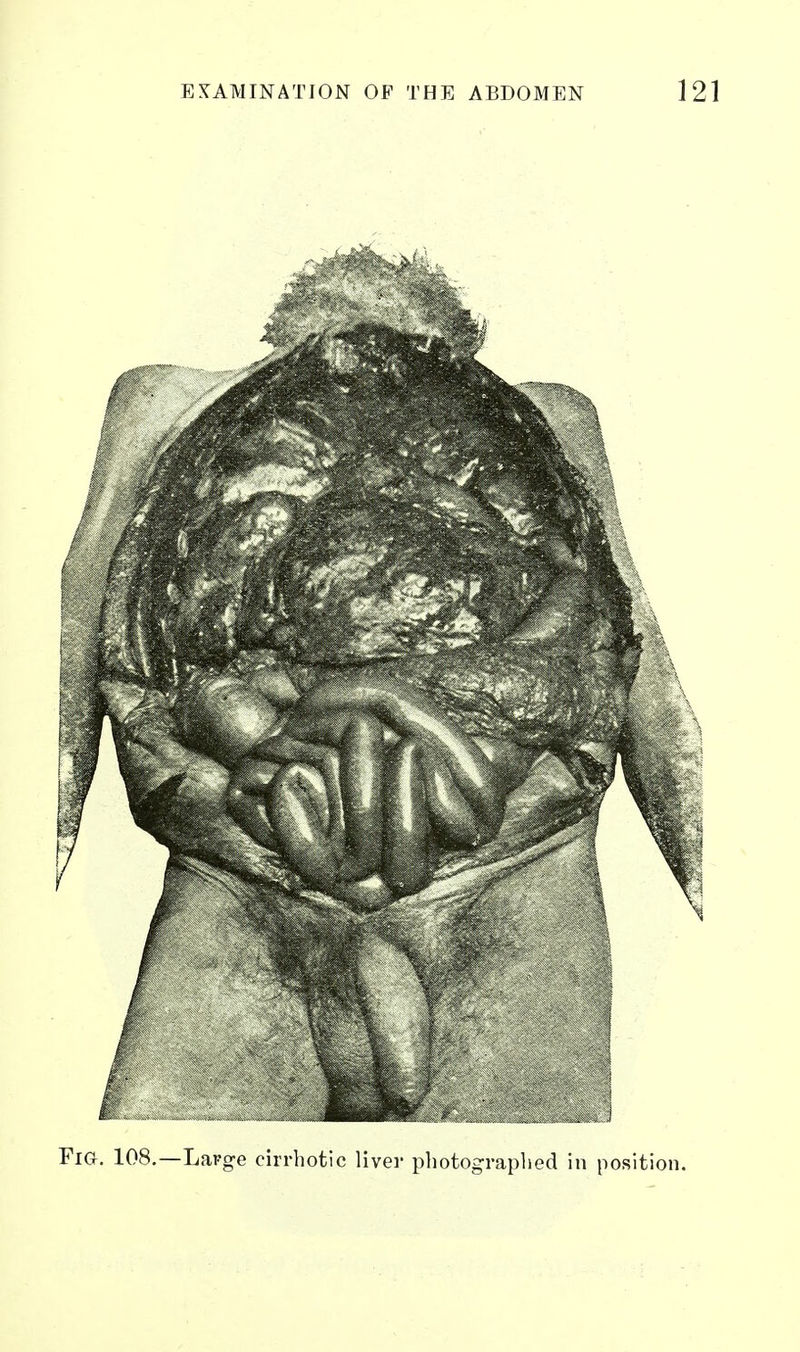 Fia. 108.—Large cirrhotic liver photograplied in position.