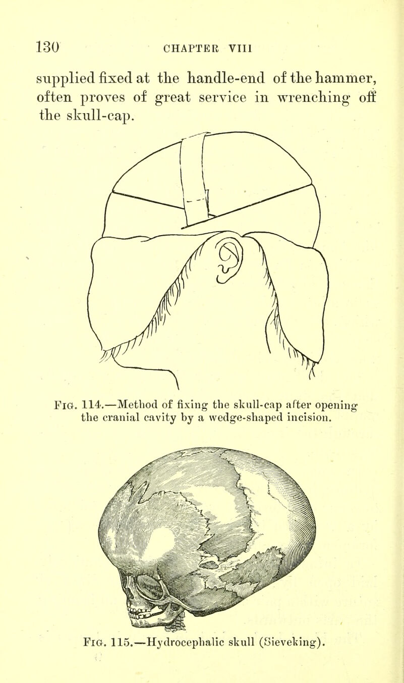 supplied fixed at tlie handle-end of the hammer, often proves of great service in wrenching off the skull-cap. Fig. 114.—Method of fixing the skull-cap after opening the cranial cavity by a wedge-shaped incision. Fig. 115.—Hydrocephalic skull (Sieveking).