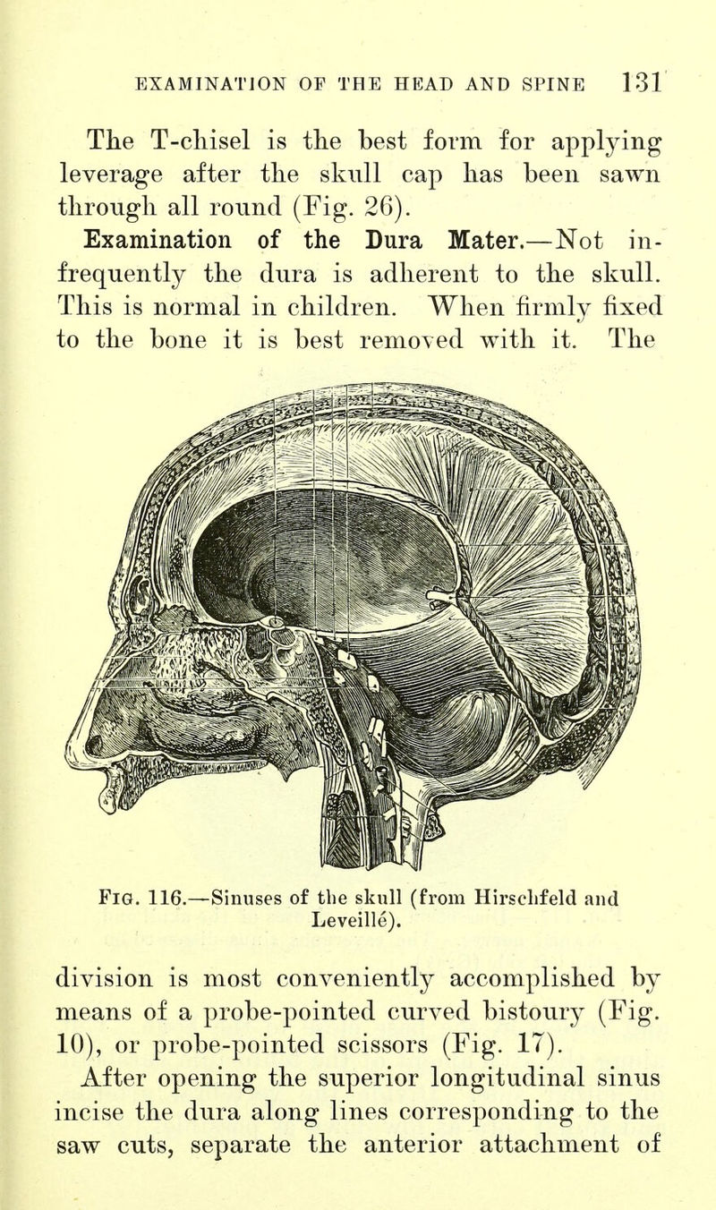 The T-cliisel is the best form for applying leverage after the skull cap has been sawn through all round (Fig. 26). Examination of the Dura Mater.—Not in- frequently the dura is adherent to the skull. This is normal in children. When firmly fixed to the bone it is best removed with it. The Fig. 116.—Sinuses of the skull (from Hirsclifeld and Leveille). division is most conveniently accomplished by means of a probe-pointed curved bistoury (Fig. 10), or probe-pointed scissors (Fig. 17). After opening the superior longitudinal sinus incise the dura along lines corresponding to the saw cuts, separate the anterior attachment of