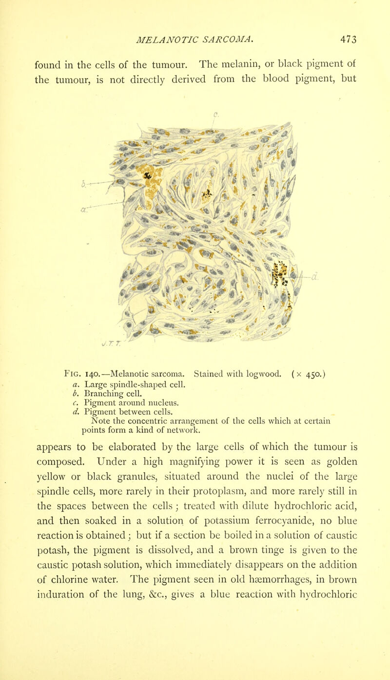 found in the cells of the tumour. The melanin, or black pigment of the tumour, is not directly derived from the blood pigment, but c. Fig. 140.—Melanotic sarcoma. Stained with logwood, (x 450.) a. Large spindle-shaped cell. b. Branching cell. c. Pigment around nucleus. d. Pigment between cells. Note the concentric arrangement of the cells which at certain points form a kind of network. appears to be elaborated by the large cells of which the tumour is composed. Under a high magnifying power it is seen as golden yellow or black granules, situated around the nuclei of the large spindle cells, more rarely in their protoplasm, and more rarely still in the spaces between the cells ; treated with dilute hydrochloric acid, and then soaked in a solution of potassium ferrocyanide, no blue reaction is obtained ; but if a section be boiled in a solution of caustic potash, the pigment is dissolved, and a brown tinge is given to the caustic potash solution, which immediately disappears on the addition of chlorine water. The pigment seen in old haemorrhages, in brown induration of the lung, &c, gives a blue reaction with hydrochloric