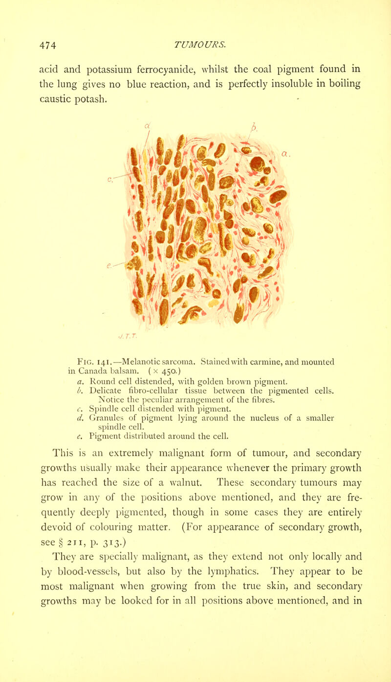 acid and potassium ferrocyanide, whilst the coal pigment found in the lung gives no blue reaction, and is perfectly insoluble in boiling caustic potash. J.T.T. Fig. 141.—Melanotic sarcoma. Stained with carmine, and mounted in Canada balsam. ( x 450.) a. Round cell distended, with golden brown pigment. b. Delicate fibro-cellular tissue between the pigmented cells. Notice the peculiar arrangement of the fibres. c. Spindle cell distended with pigment. d. Granules of pigment lying around the nucleus of a smaller spindle cell. e. Pigment distributed around the cell. This is an extremely malignant form of tumour, and secondary growths usually make their appearance whenever the primary growth has reached the size of a walnut. These secondary tumours may grow in any of the positions above mentioned, and they are fre- quently deeply pigmented, though in some cases they are entirely devoid of colouring matter. (For appearance of secondary growth, see § 211, p. 313.) They are specially malignant, as the)- extend not only locally and by blood-vessels, but also by the lymphatics. They appear to be most malignant when growing from the true skin, and secondary growths may be looked for in all positions above mentioned, and in