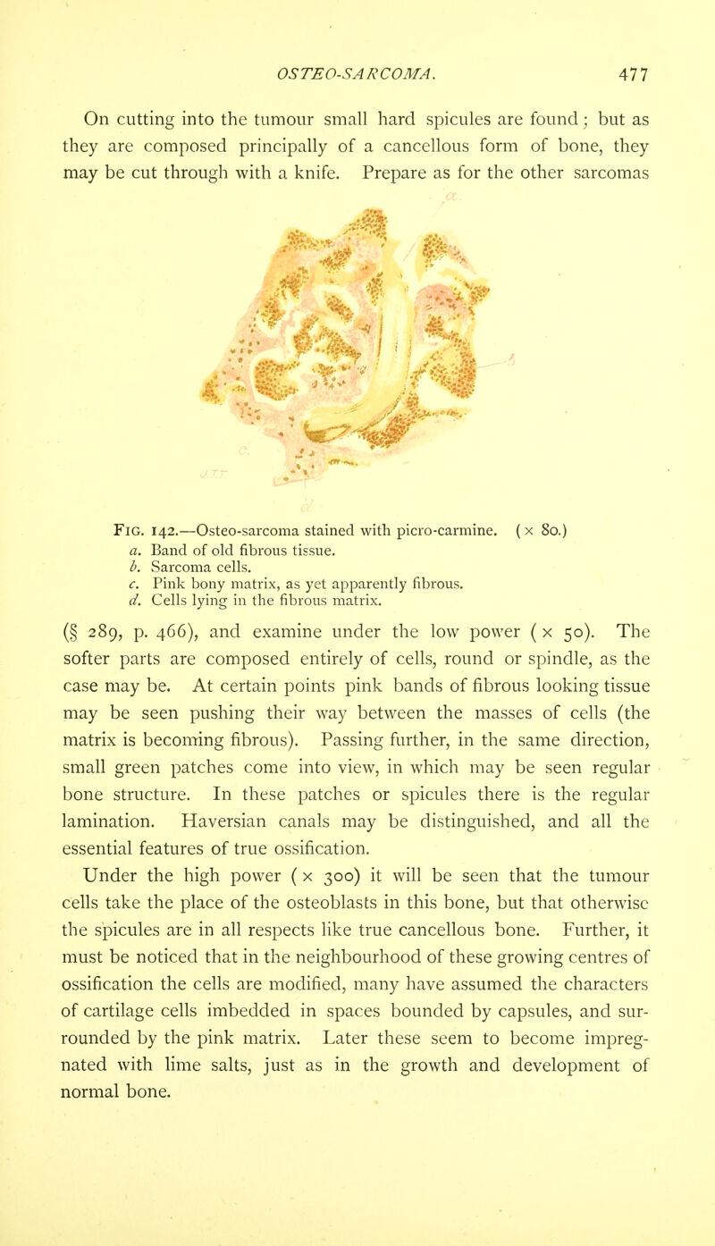 On cutting into the tumour small hard spicules are found; but as they are composed principally of a cancellous form of bone, they may be cut through with a knife. Prepare as for the other sarcomas Fig. 142.—Osteosarcoma stained with picro-carmine. ( x 80.) a. Band of old fibrous tissue. b. Sarcoma cells. c. Pink bony matrix, as yet apparently fibrous. d. Cells lying in the fibrous matrix. (§ 289, p. 466), and examine under the low power ( x 50). The softer parts are composed entirely of cells, round or spindle, as the case may be. At certain points pink bands of fibrous looking tissue may be seen pushing their way between the masses of cells (the matrix is becoming fibrous). Passing further, in the same direction, small green patches come into view, in which may be seen regular bone structure. In these patches or spicules there is the regular lamination. Haversian canals may be distinguished, and all the essential features of true ossification. Under the high power (x 300) it will be seen that the tumour cells take the place of the osteoblasts in this bone, but that otherwise the spicules are in all respects like true cancellous bone. Further, it must be noticed that in the neighbourhood of these growing centres of ossification the cells are modified, many have assumed the characters of cartilage cells imbedded in spaces bounded by capsules, and sur- rounded by the pink matrix. Later these seem to become impreg- nated with lime salts, just as in the growth and development of normal bone.