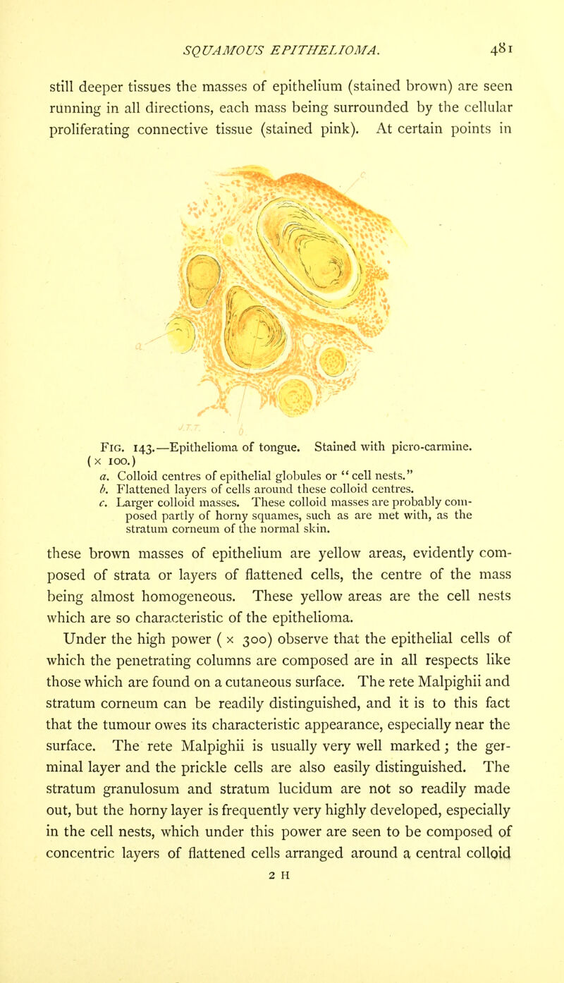 SQ UAMOUS EPITHELIOMA. still deeper tissues the masses of epithelium (stained brown) are seen running in all directions, each mass being surrounded by the cellular proliferating connective tissue (stained pink). At certain points in Fig. 143.—Epithelioma of tongue. Stained with picro-carmine. (x 100.) a. Colloid centres of epithelial globules or  cell nests. b. Flattened layers of cells around these colloid centres. c. Larger colloid masses. These colloid masses are probably com- posed partly of horny squames, such as are met with, as the stratum corneum of the normal skin. these brown masses of epithelium are yellow areas, evidently com- posed of strata or layers of flattened cells, the centre of the mass being almost homogeneous. These yellow areas are the cell nests which are so characteristic of the epithelioma. Under the high power ( x 300) observe that the epithelial cells of which the penetrating columns are composed are in all respects like those which are found on a cutaneous surface. The rete Malpighii and stratum corneum can be readily distinguished, and it is to this fact that the tumour owes its characteristic appearance, especially near the surface. The rete Malpighii is usually very well marked; the ger- minal layer and the prickle cells are also easily distinguished. The stratum granulosum and stratum lucidum are not so readily made out, but the horny layer is frequently very highly developed, especially in the cell nests, which under this power are seen to be composed of concentric layers of flattened cells arranged around a central colloid 2 H