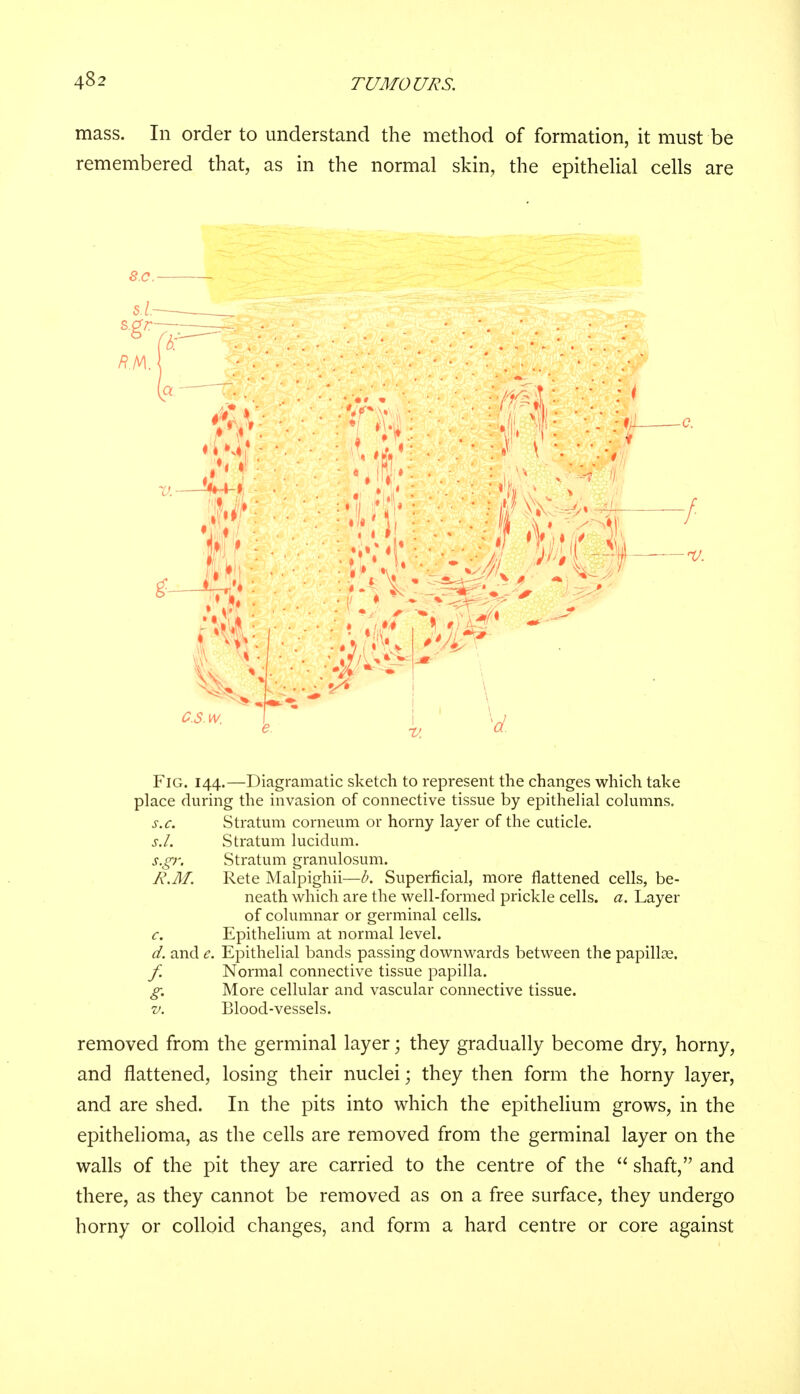mass. In order to understand the method of formation, it must be remembered that, as in the normal skin, the epithelial cells are sc. Fig. 144.—Diagramatic sketch to represent the changes which take place during the invasion of connective tissue by epithelial columns. s.c. Stratum corneum or horny layer of the cuticle. s.L Stratum lucidum. s.gr. Stratum granulosum. R.M. Rete Malpighii—b. Superficial, more flattened cells, be- neath which are the well-formed prickle cells, a. Layer of columnar or germinal cells. c. Epithelium at normal level. d. and e. Epithelial bands passing downwards between the papillae. f. Normal connective tissue papilla. g. More cellular and vascular connective tissue. v. Blood-vessels. removed from the germinal layer; they gradually become dry, horny, and flattened, losing their nuclei; they then form the horny layer, and are shed. In the pits into which the epithelium grows, in the epithelioma, as the cells are removed from the germinal layer on the walls of the pit they are carried to the centre of the  shaft, and there, as they cannot be removed as on a free surface, they undergo horny or colloid changes, and form a hard centre or core against
