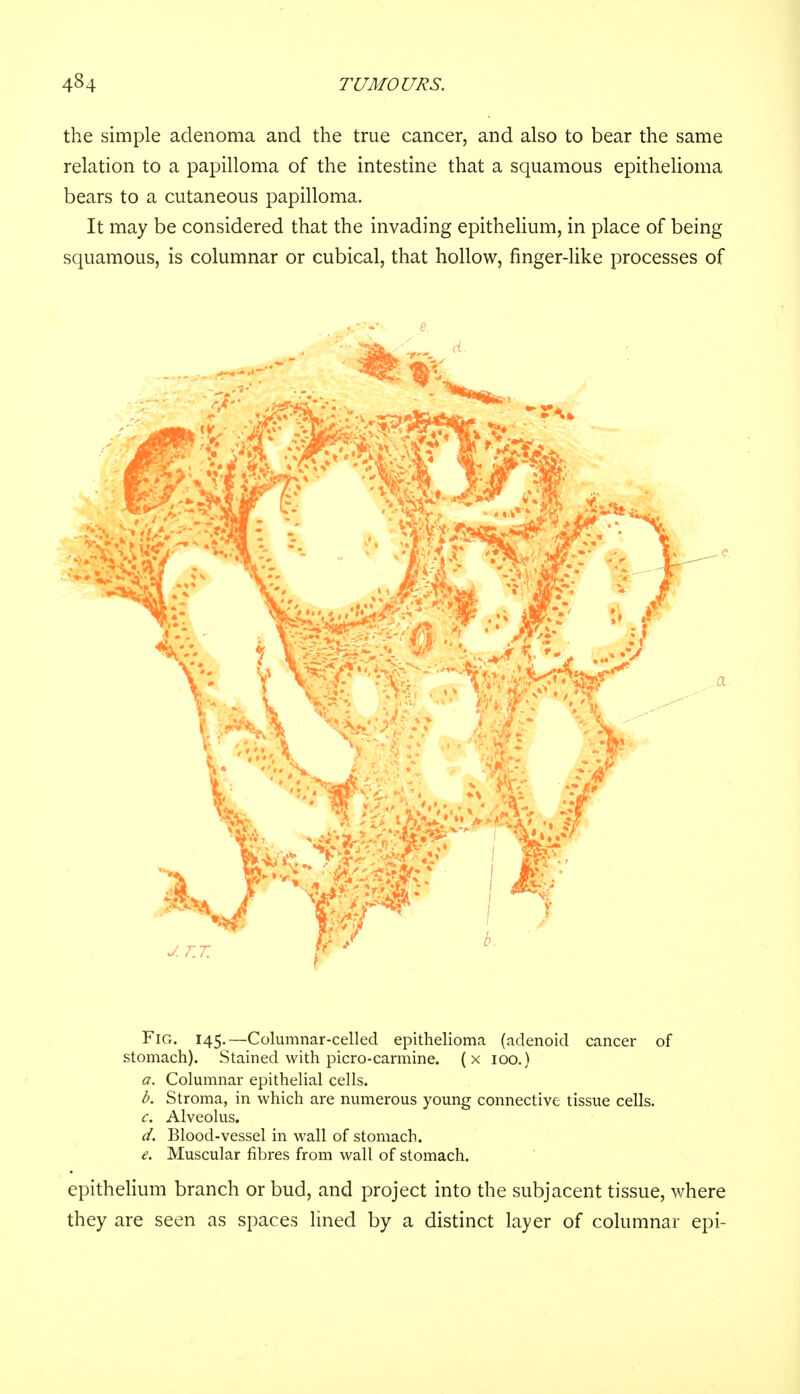 the simple adenoma and the true cancer, and also to bear the same relation to a papilloma of the intestine that a squamous epithelioma bears to a cutaneous papilloma. It may be considered that the invading epithelium, in place of being squamous, is columnar or cubical, that hollow, finger-like processes of e. Fig. 145.—Columnar-celled epithelioma (adenoid cancer of stomach). Stained with picro-carmine. (x 100.) a. Columnar epithelial cells. b. Stroma, in which are numerous young connective tissue cells. c. Alveolus. d. Blood-vessel in wall of stomach. e. Muscular fibres from wall of stomach. epithelium branch or bud, and project into the subjacent tissue, where they are seen as spaces lined by a distinct layer of columnar epi-