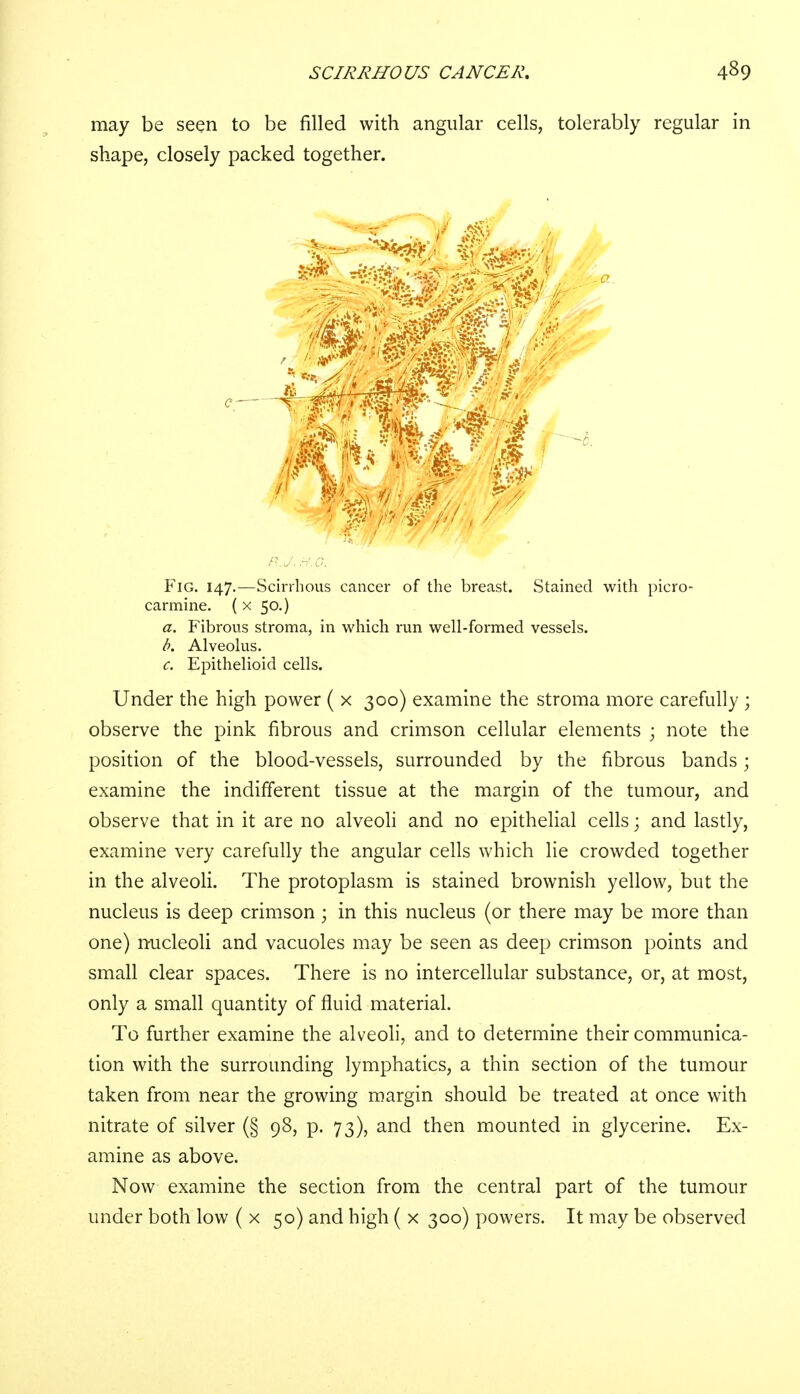 may be seen to be filled with angular cells, tolerably regular in shape, closely packed together. v. c^*y jp ; '--tt/jS w k ■■■■ Fig. 147.—Scirrhous cancer of the breast. Stained with picro- carmine. ( x 50.) a. Fibrous stroma, in which run well-formed vessels. b. Alveolus. c. Epithelioid cells. Under the high power ( x 300) examine the stroma more carefully ; observe the pink fibrous and crimson cellular elements ; note the position of the blood-vessels, surrounded by the fibrous bands; examine the indifferent tissue at the margin of the tumour, and observe that in it are no alveoli and no epithelial cells; and lastly, examine very carefully the angular cells which lie crowded together in the alveoli. The protoplasm is stained brownish yellow, but the nucleus is deep crimson ; in this nucleus (or there may be more than one) nucleoli and vacuoles may be seen as deep crimson points and small clear spaces. There is no intercellular substance, or, at most, only a small quantity of fluid material. To further examine the alveoli, and to determine their communica- tion with the surrounding lymphatics, a thin section of the tumour taken from near the growing margin should be treated at once with nitrate of silver (§ 98, p. 73), and then mounted in glycerine. Ex- amine as above. Now examine the section from the central part of the tumour under both low ( x 50) and high ( x 300) powers. It may be observed
