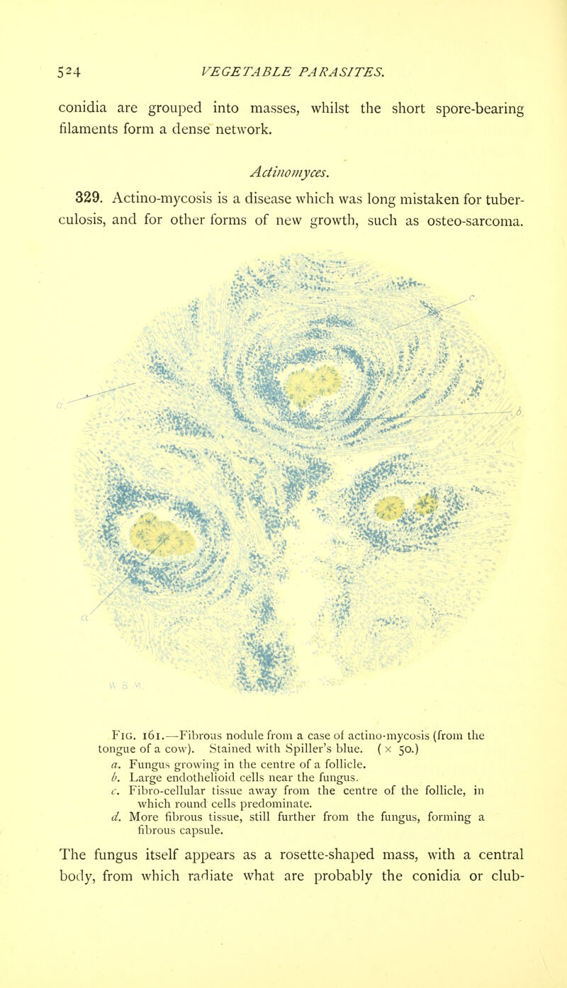 conidia are grouped into masses, whilst the short spore-bearing filaments form a dense network. Actinomyces. 329. Actino-mycosis is a disease which was long mistaken for tuber- culosis, and for other forms of new growth, such as osteo-sarcoma. Fig. 161.—Fibrous nodule from a case of actino-mycosis (from the tongue of a cow). Stained with Spiller's blue. ( x 50.) a. Fungus growing in the centre of a follicle. b. Large endothelioid cells near the fungus. c. Fibro-cellular tissue away from the centre of the follicle, in which round cells predominate. d. More fibrous tissue, still further from the fungus, forming a fibrous capsule. The fungus itself appears as a rosette-shaped mass, with a central body, from which radiate what are probably the conidia or club-