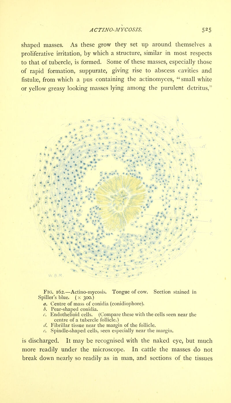 shaped masses. As these grow they set up around themselves a proliferative irritation, by which a structure, similar in most respects to that of tubercle, is formed. Some of these masses, especially those of rapid formation, suppurate, giving rise to abscess cavities and fistulae, from which a pus containing the actinomyces, small white or yellow greasy looking masses lying among the purulent detritus, W. B.M Fig. 162.—Actinomycosis. Tongue of cow. Section stained in Spiller's blue. ( x 300.) a. Centre of mass of conidia (conidiophore). b. Pear-shaped conidia. c. Endothelioid cells. (Compare these with the cells seen near the centre of a tubercle follicle.) d. Fibrillar tissue near the margin of the follicle. e. Spindle-shaped cells, seen especially near the margin. is discharged. It may be recognised with the naked eye, but much more readily under the microscope. In cattle the masses do not break down nearly so readily as in man, and sections of the tissues