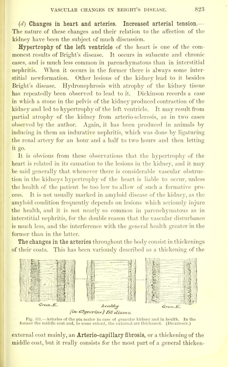 (d) Changes in heart and arteries. Increased arterial tension.— The nature of these changes and their relation to the affection of the kidney have been the subject of much discussion. Hypertrophy of the left ventricle of the heart is one of the com- monest results of Bright's disease. It occurs in subacute and chronic cases, and is much less common in parenchymatous than in interstitial nephritis. When it occurs in the former there is always some inter- stitial newformation. Other lesions of the kidney lead to it besides Bright's disease. Hydronephrosis with atrophy of the kidney tissue has repeatedly been observed to lead to it. Dickinson records a case in which a stone in the pelvis of the kidney produced contraction of the kidney and led to hypertrophy of the left ventricle. It may result from partial atrophy of the kidney from arterio-sclerosis, as in two cases observed by the author. Again, it has been produced in animals by inducing in them an indurative nephritis, which was done by ligaturing the renal artery for an hour and a half to two hours and then letting it go. It is obvious from these observations that the hypertrophy of the heart is related in its causation to the lesions in the kidney, and it may be said generally that whenever there is considerable vascular obstruc- tion in the kidneys hypertrophy of the heart is liable to occur, unless the health of the patient be too low to allow of such a formative pro- cess. It is not usually marked in amyloid disease of the kidney, as the amyloid condition frequently depends on lesions which seriously injure the health, and it is not nearly so common in parenchymatous as in interstitial nephritis, for the double reason that the vascular disturbance is much less, and the interference with the general health greater in the former than in the latter. The changes in the arteries throughout the body consist in thickenings of their coats. This has been variously described as a thickening of the (w€Flgvertne<) /SO diams. Fitf. 311.—Arteries of the pia mater in case of granular kidney and in health. In the former the middle coat and, to some extent, the external are thickened. (Dickinson.) external coat mainly, an Arterio-capillary fibrosis, or a thickening of the middle coat, but it really consists for the most part of a general thicken-