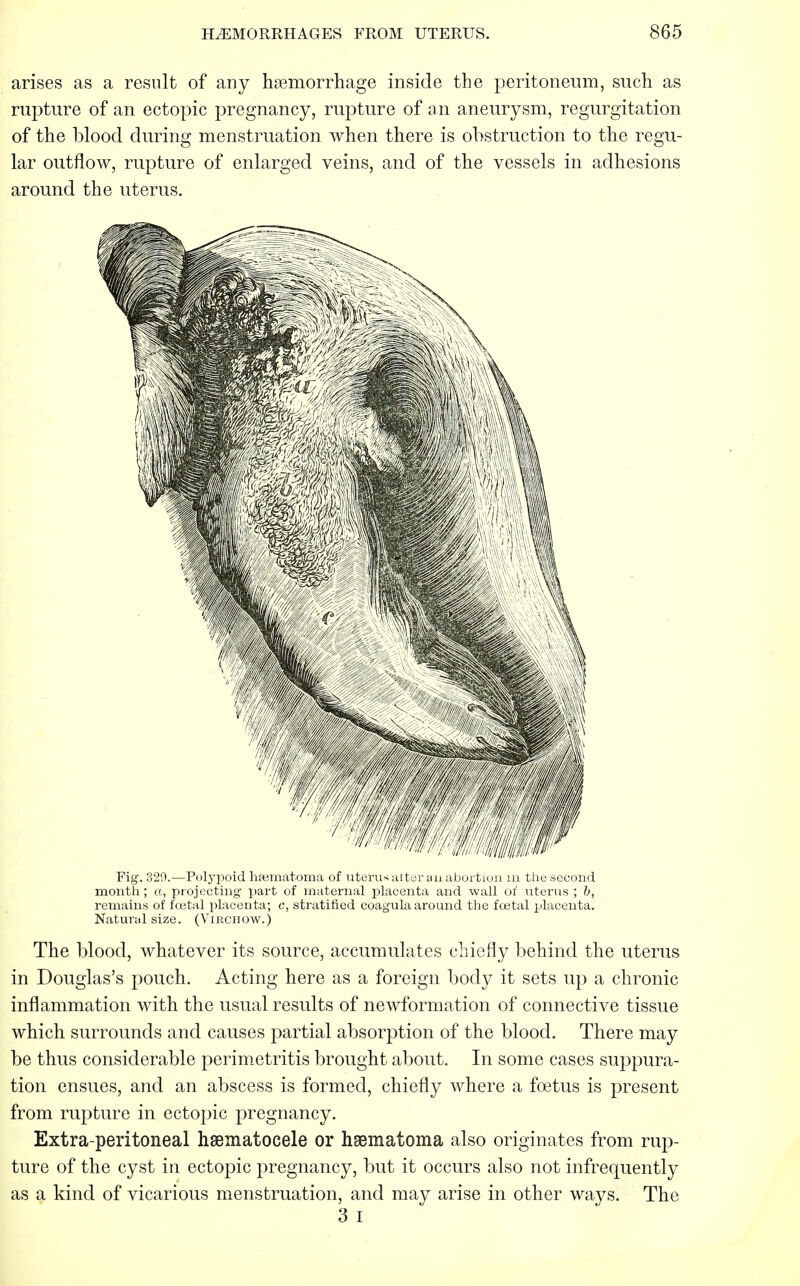 arises as a result of any haemorrhage inside the peritoneum, such as rupture of an ectopic pregnancy, rupture of an aneurysm, regurgitation of the blood during menstruation when there is obstruction to the regu- lar outflow, rupture of enlarged veins, and of the vessels in adhesions around the uterus. Fig. 329.—Polypoid haematoma of uterus alter an abortion in the second month; a, projecting- part of maternal placenta and wall of uterus ; b, remains of foetal placenta; c, stratified coagula around the foetal placenta. Natural size. (Virchow.) The blood, whatever its source, accumulates chiefly behind the uterus in Douglas's pouch. Acting here as a foreign body it sets up a chronic inflammation with the usual results of newformation of connective tissue which surrounds and causes partial absorption of the blood. There may be thus considerable perimetritis brought about. In some cases suppura- tion ensues, and an abscess is formed, chiefly where a foetus is present from rupture in ectopic pregnancy. Extra-peritoneal hematocele or hsematoma also originates from rup- ture of the cyst in ectopic pregnancy, but it occurs also not infrequently as a kind of vicarious menstruation, and may arise in other ways. The 3 I