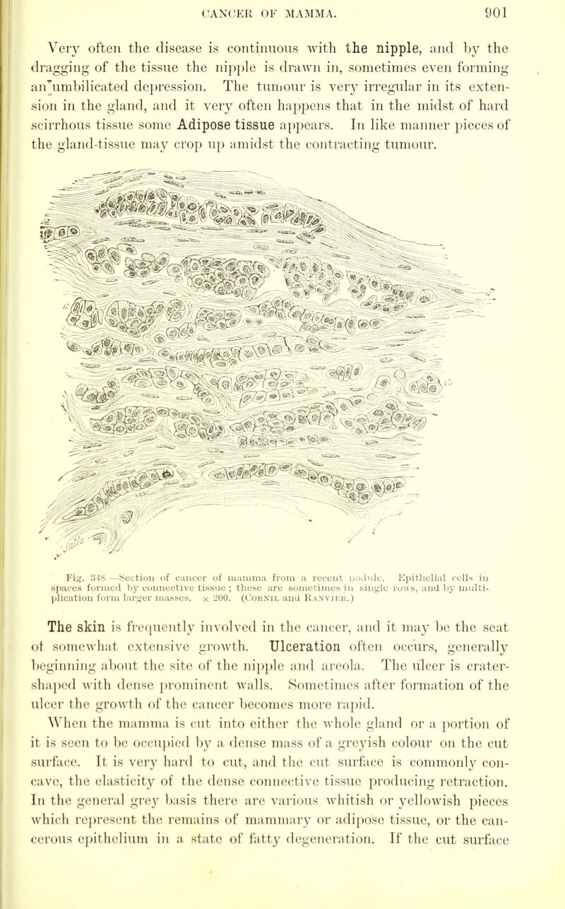 Very often the disease is continuous with the nipple, and by the dragging of the tissue the nipple is drawn in, sometimes even forming an'umbilicated depression. The tumour is very irregular in its exten- sion in the gland, and it very often happens that in the midst of hard scirrhous tissue some Adipose tissue appears. In like manner pieces of the gland-tissue may crop up amidst the contracting tumour. Via. 348.—Section of cancer of mamma from a recent nodule. Epithelial cells in spaces formed hy connective tissue ; these are sometimes in single rows, and by multi- plication form larger masses, x -00. (Cornil and Raxvikk.) The skin is frequently involved in the cancer, and it may be the seat of somewhat extensive growth. Ulceration often occurs, generally beginning about the site of the nipple and areola. The ulcer is crater- shaped with dense prominent walls. Sometimes after formation of the ulcer the growth of the cancer becomes more rapid. When the mamma is cut into either the whole gland or a portion of it is seen to be occupied by a dense mass of a greyish colour on the cut surface. It is very hard to cut, and the cut surface is commonly con- cave, the elasticity of the dense connective tissue producing retraction. In the general grey basis there are various whitish or yellowish pieces which represent the remains of mammary or adipose tissue, or the can- cerous epithelium in a state of fatty degeneration. If the cut surface