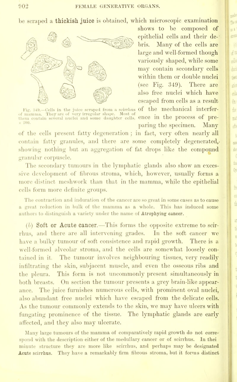 be scraped a thickish juice is obtained, which microscopic examination shows to be composed of epithelial cells and their de-' bris. Many of the cells are large and well-formed though variously shaped, while some may contain secondary cells within them or double nuclei (see Fig. 349). There are also free nuclei which have escaped from cells as a result Fig< 349.—Cells in the juice scraped from a scirrhus of the mechanical illterfer- of mamma. They are of very irregular shape. Most of . , „ them contain several nuclei and .some daughter colls, ence 111 the process 01 pre- paring the specimen. Many of the cells present fatty degeneration ; in fact, very often nearly all contain fatty granules, and there are some completely degenerated,- showing nothing but ;m aggregation of fat drops like the compound granular corpuscle. Tlir secondary tumours in the lymphatic glands also show an exces- sive development of fibrous stroma, which, however, usually forms a more distind meshwork than that in the mamma, while the epithelial cells form more definite groups. The contraction and induration of the cancer are so great in some cases as to cause a great reduction in bulk of the mamma as a whole. This has induced some authors to distinguish a variety under the name of Atrophying cancer. (It) Solt or Acute cancer.—This forms the opposite extreme to scir- rhus, and there are all intervening grades. In the soft cancer we have a bulky tumour of soft consistence and rapid growth. There is a well-formed alveolar stroma, and the cells are somewhat loosely con- tained in it. The tumour involves neighbouring tissues, very readily infiltrating the skin, subjacent muscle, and even the osseous ribs and the pleura. This form is not uncommonly present simultaneously in both breasts. On section the tumour presents a grey brain-like appear- ance. The juice furnishes numerous cells, with prominent oval nuclei, also abundant free nuclei which have escaped from the delicate cells. As the tumour commonly extends to the skin, we may have ulcers with fungating prominence of the tissue. The lymphatic glands are early affected, and they also may ulcerate. Many large tumours of the mamma of comparatively rapid growth do not corre- spond with the description either of the medullary cancer or of scirrhus. In thei minute structure they are more like scirrhus, and perhaps may be designated Acute scirrhus. Thcv have a remarkably firm fibrous stroma, but it forms distinct
