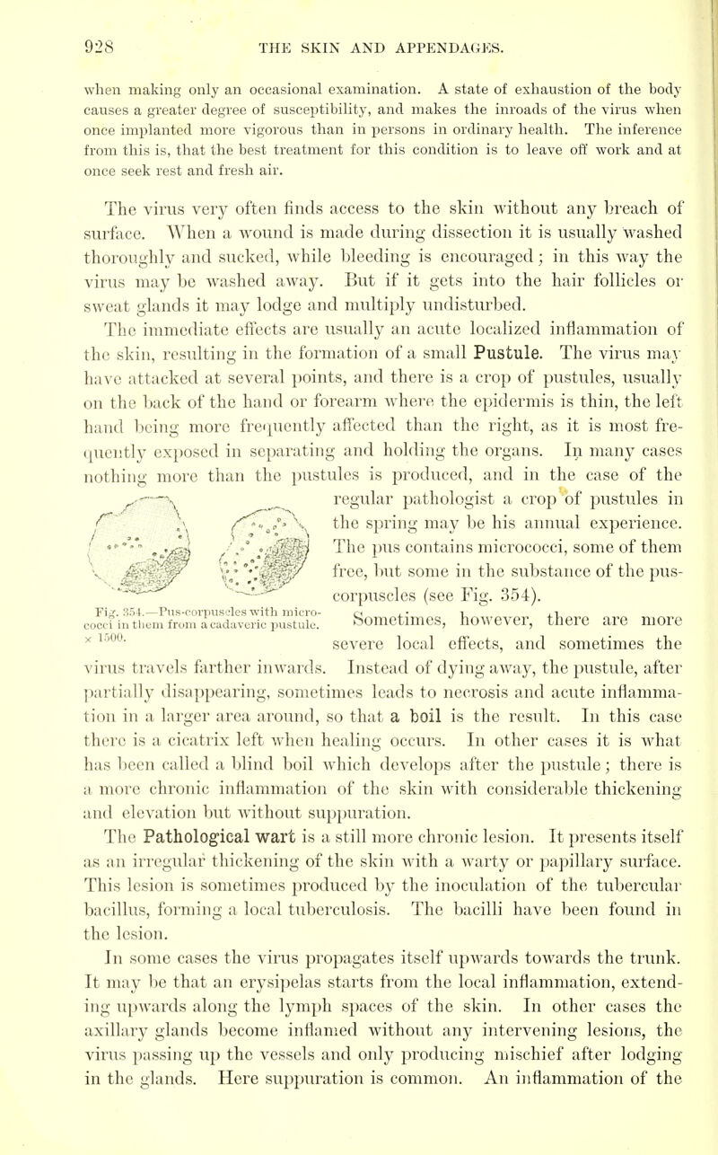 when making only an occasional examination. A state of exhaustion of the body causes a greater degree of susceptibility, and makes the inroads of the virus when once implanted more vigorous than in persons in ordinary health. The inference from this is, that the best treatment for this condition is to leave off work and at once seek rest and fresh air. The virus very often finds access to the skin without any breach of surface. When a wound is made during dissection it is usually washed thoroughly and sucked, while bleeding is encouraged; in this way the virus may be washed away. But if it gets into the hair follicles or sweat glands it may lodge and multiply undisturbed. The immediate effects are usually an acute localized inflammation of the skin, resulting in the formation of a small Pustule. The virus may have attacked at several points, and there is a crop of pustules, usually on the back of the hand or forearm where the epidermis is thin, the left hand being more frequently affected than the right, as it is most fre- quently exposed in separating and holding the organs. In many cases nothing more than the pustules is produced, and in the case of the r.—^ regular pathologist a crop of pustules in f \\ f^>a°>\ the spring may be his annual experience. ' ■ , , f * \ The pus contains micrococci, some of them :••' v/ TY free, but some in the substance of the pus- -w^- corpuscles (see Fig. 354). Fij. 354.—Pus-corpuscles with micro- ei j_* 1 j_i cocci in them from a cadaveric pustule. bometimes, however, there are more x severe local effects, and sometimes the virus travels farther inwards. Instead of dying away, the pustule, after partially disappearing, sometimes leads to necrosis and acute inflamma- tion in a larger area around, so that a boil is the result. In this case there is a cicatrix left when healing occurs. In other cases it is what has been called a blind boil which develops after the pustule; there is a more chronic inflammation of the skin with considerable thickening and elevation but without suppuration. The Pathological wart is a still more chronic lesion. It presents itself as an irregular thickening of the skin with a warty or papillary surface. This lesion is sometimes produced by the inoculation of the tubercular bacillus, forming a local tuberculosis. The bacilli have been found in the lesion. In some cases the virus propagates itself upwards towards the trunk. It may be that an erysipelas starts from the local inflammation, extend- ing upwards along the lymph spaces of the skin. In other cases the axillary glands become inflamed without any intervening lesions, the virus passing up the vessels and only producing mischief after lodging in the glands. Here suppuration is common. An inflammation of the