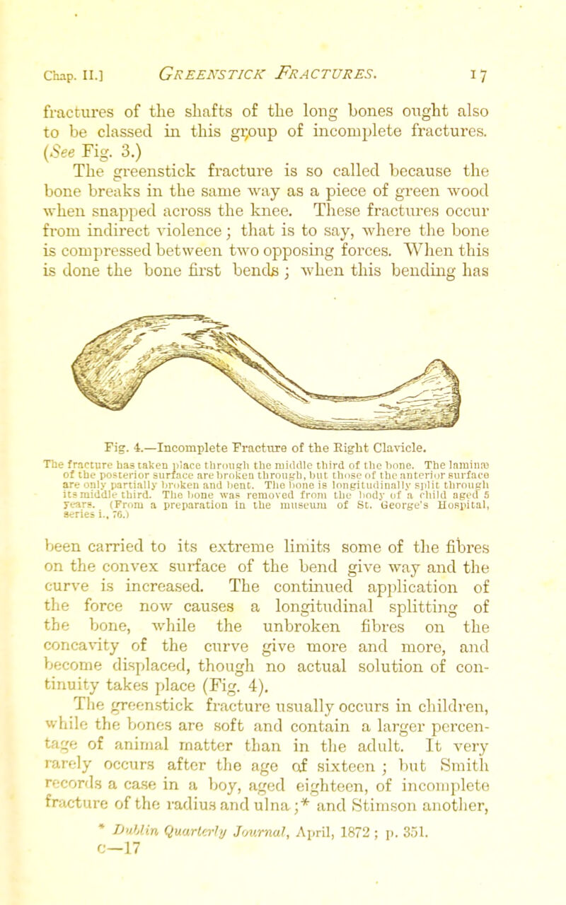 fractures of the shafts of the long bones ought also to be classed in this gi;oup of incomj^lete fractures. (-See Fig. 3.) The greenstick fracture is so called because the bone breaks in the same way as a piece of green wood when snapped across the knee. These fractures occur from indirect violence; that is to say, where the bone is compressed between two oiDposing forces. When this is done the bone first bends ; when this bending has Fig. 4.—Incomplete Fracture of the Eight Clavicle. The fracture has taken place tlinmgli the middle third of the hnne. The Inminro of the posterior surface arehrokea throuf,'h, but those of the anterior surface are only partially broken anil bent. The bone is longitudinally split through its middle third. The bone was removed from the body of a child aged 5 years. (From a preparation in the museum of St. George's Uospital, series i,. ro been carried to its extreme limits some of the fibres on the convex surface of the bend give way and the curve is increased. The continued application of the force now causes a longitudinal splitting of the bone, while the unbroken fibres on the conca%-ity of the curve give more and more, and become displaced, though no actual solution of con- tinuity takes place (Fig. 4). The greenstick fracture u.sually occurs in children, while the bones are soft and contain a larger percen- tage of animal matter than in the adult. It very rarely occurs after the age of sixteen ; but Smith records a ca.se in a boy, aged eighteen, of incomplete fracture of the radius and ulna;* and Stim.son another, * DuUin Quarterly Journal, AyxW, 1872 ; p. 3.51. c—17
