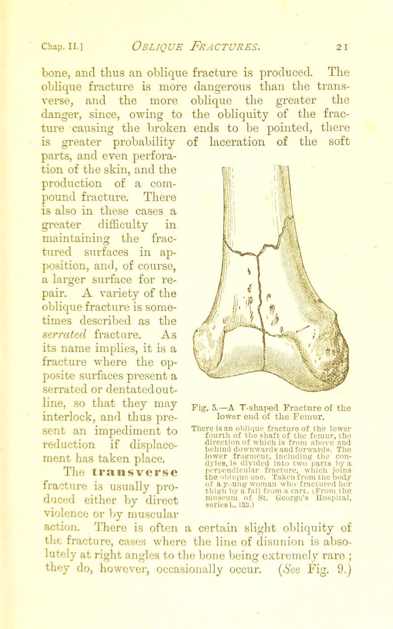bone, and thus an oblique fracture is produced. The oblique fracture is more dangerous than the trans- verse, and the more oblique the greater the danger, since, owing to the obliquity of the frac- tiu'e causing the broken ends to be pointed, there is greater probability of laceration of the soft pai'ts, and even perfora- tion of the skin, and the production of a com- pound fracture. There is also in these cases a gi'eater difficulty in maintaining the frac- tiu'ed surfaces in ap- position, and, of course, a larger surface for re- pair. A variety of the oblique fracture is some- times described as the serrated fracture. As its name implies, it is a fracture where the op- posite surfaces present a serrated or dentated out- line, so that they may interlock, and thus pre- sent an impediment to reduction if displace- ment has taken place. The transverse fracture is usually pro- duced either by direct violence or by muscular action. There is often a certain sliglit ol)liquity of the fracture, cases where the line of disunion is abso- lutely at right angles to the bone being extremely rare ; they do, however, occa.sionally occur. (<S'cie Pig. 9.) Fig. 5.—A T-shapecl Fracture of the lower end of the Femur. There is an obliqui' fracturo of the lower fourth of the shaft of the feiuur, the direction of which is from above and heliind downwards and forward.. The lower fr.ifrnieut, innhiding the con- dyles, i.s divided into two parts by a perpendicular fracture, which joins the iibhquc one. Taken from the body of a ynuiig woman wiio fractured lier thigh liy a fall from a cart. tFroni the musi'um of St. George's Hospital, series i., 133.)