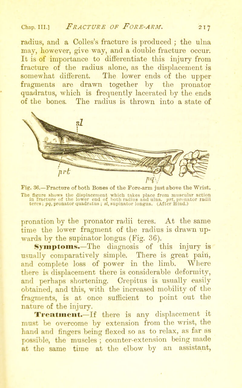 Chap. III.] Fracture of Fore-arm. 2T7 radius, and a CoUes's fracture is produced ; the ulna may, however, give way, and a double fracture occui'. It is of importance to differentiate tliis injury from fractxu'e of the radius alone, as the displacement is somewhat difierent. The lower ends of the upper fragments are drawn together by the pronator quadratus, which is frequently lacerated by the ends of the bones. The radius is thrown into a state of Fie. 36.—Fracture of both Bones of the Fore-arm just above the Wrist. The fitfiire shows the displ.iceiiient which takes place from imisciilar action in fracture of the lower end of both radius and ulna, frt, pronator radii teres; pg, pronator iiuadratus ; s(, supinator longus. tAfter Hind.) pronation by the pronator radii teres. At the same time the lower fragment of the radius is drawn up- wards by the supinator longus (B'ig. 36). Symptoms.—The diagnosis of this injury is usually comparatively simple. There is great pain, and complete loss of power in the limb. Where there is displacement there is considerable deformity, and perhaps shortening. Crepitus is usually easily obtained, and this, with the increased mobility of the fragments, is at once sufficient to point out the nature of the injury. Treatment.—If there is any displacement it must be overcome by extension from the wrist, the hand and fingers V^eing flexed so as to relax, as far as pos.sible, the muscles ; counter-extension being made at the same time at the elbow by an assistant,