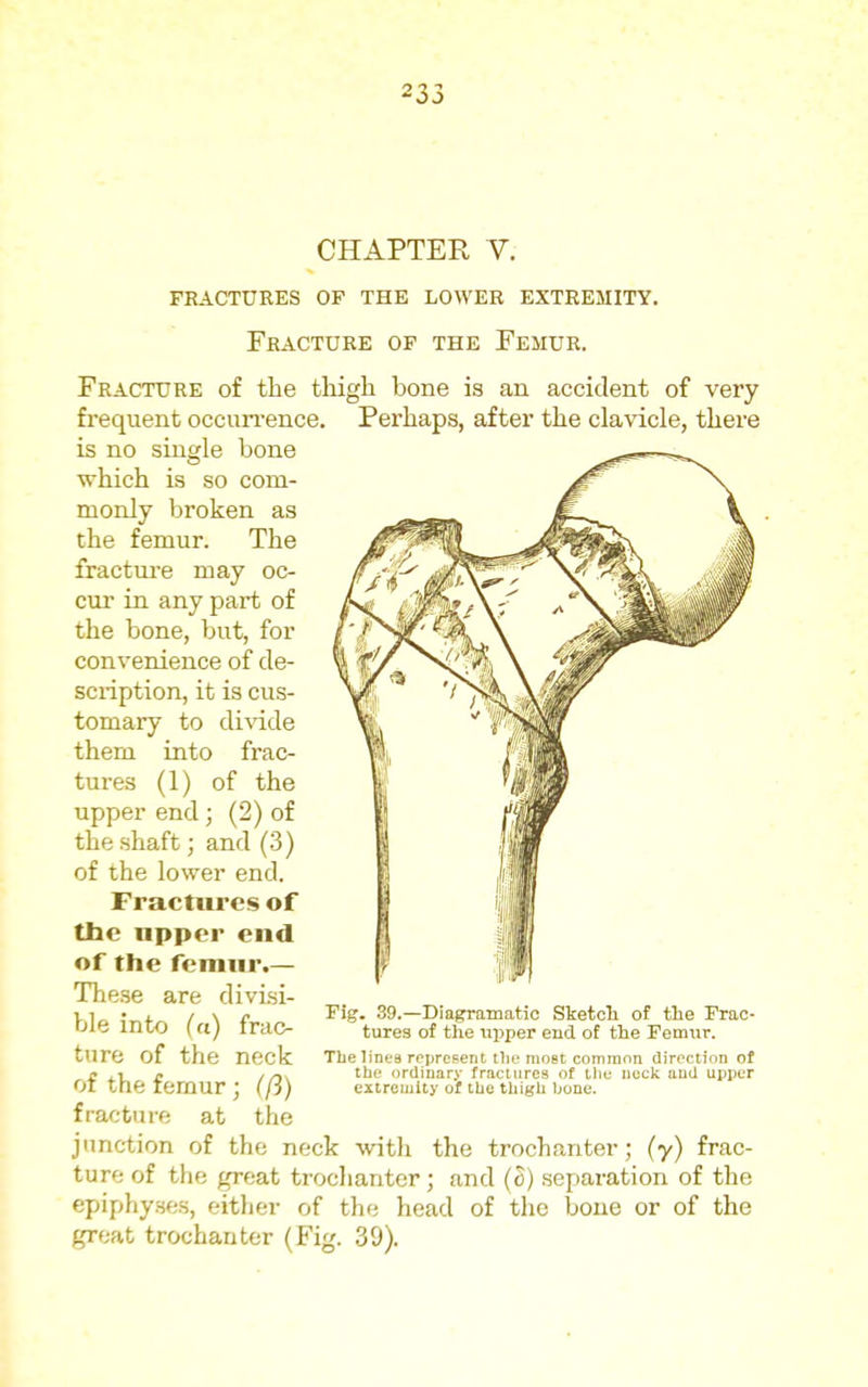 CHAPTER V. fractures of the lower extremity. Fracture of the Femur. Fracture of the thigh bone is an accident of very- frequent occun'ence. Perhaps, after the clavicle, there is no single bone which is so com- monly broken as the femur. The fracture may oc- cur in any part of the bone, but, for convenience of de- scription, it is cus- tomary to divide them into frac- tures (1) of the upper end; (2) of the shaft; and (3) of the lower end. Fractures of the npper end of the femnr.— These are divisi- ble into (a) frac- ture of the neck of the femur ; (ft) fracture at the junction of the neck with the trochanter; (y) frac- ture of the great trochanter; and (c) separation of the epiphyses, either of the head of the boue or of the great trochanter (Fig. 39). Fig. 39.—Diagramatic Sketch of the Frac- tures of the upper end of the Femur. The lines represent Ihc most comninn directinn of the ordinary fractures of tliu neck and upper extremity of the thigh bone.