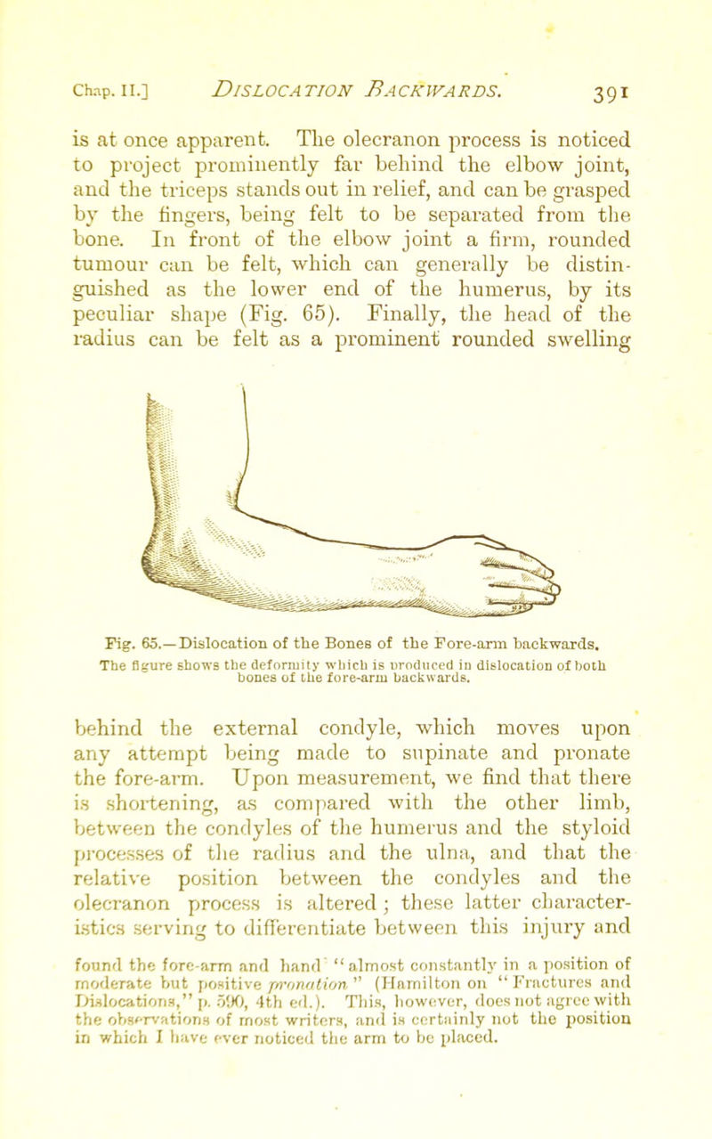 is at once apparent. The olecranon process is noticed to project prominently far behind the elbow joint, and the triceps stands out in relief, and can be grasped by the fingers, being felt to be separated from the bone. In fi-ont of the elbow joint a firm, rounded tumour can be felt, which can generally be distin- guished as the lower end of the humerus, by its peculiar shape (Fig. 65). Finally, the head of the radius can be felt as a prominent rounded swelling Pig. 65.—Dislocation of the Bones of tbe Fore-arm backwards. The figure shows the deformity which is urndiioed in dislocation of both bones of the fore-arm backwards. behind the extei'nal condyle, which moves upon any attempt being made to supinate and pronate the fore-arm. Upon measurement, we find that there i.s shortening, as compared with the other limb, between the condyles of the humerus and the styloid processes of the radius and the ulna, and that the relative position between the condyles and the olecranon process is altered ; these latter character- Lstics serving to differentiate between this injury and found the fore-arm and hand' almost constantly in a position of moderate h\it fiositive jrn-onation  (Hamilton on  Fractures and Iji.Hlocations, I). .5'Jf), 4th ed.). Tliis, however, does not agree with the ohsf-rvation.H of most writers, and is certainly not the position in which I liave ever noticed tlie arm to be placed.