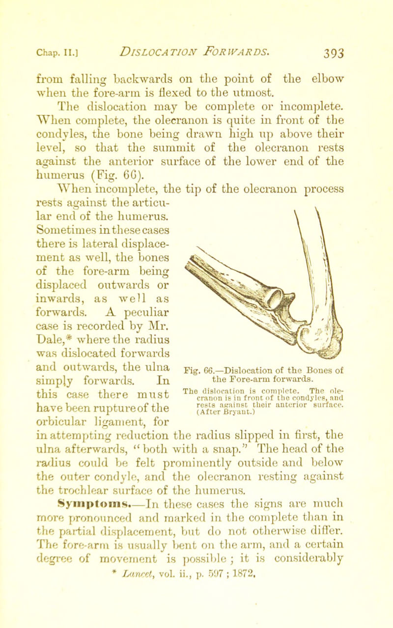 from falling backwards on the point of tlie elbow when the fore-arm is flexed to the utmost. Tlie dislocation may be complete or incomplete. When complete, the olecranon is quite in front of the condyles, the bone being drawn high up above their level, so that the summit of the olecranon rests against the anterior surface of the lower end of the humerus (Fig. 6G). When incomplete, the tip of the olecranon process rests against the articu- lar end of the humerus. Sometimes in these cases there Ls lateral displace- ment as well, the bones of the fore-arm being displaced outwards or inwards, as well as forwards. A pec\iliar case is recorded by Mr. Dale,* where the radius was di-slocated forwards and outwards, the ulna simply forwards. In this case there must have been rupture of the orbicular ligament, for in attempting reduction the radius slipped in first, the ulna after^vards,  both with a snap. The head of the ra/lius could be felt prominently outside and below the outer condyle, and the olecranon resting against the trochlear surface of the humerus. Syinptom«).—In these cases the signs are much more pronounced and marked in the complete than in the partial displacement, but do not otherwise differ. The fore-arm is usually bent on the arm, and a certain degree of movement is possible ; it is considerably • UinrM, vol. ii., p. 507 ; 1872. Fig. 66.—Dislocation of the Bones o£ tlie Fore-arm forwards. The dislocation is complete. The ole- cranon is in front of the condyles, and rests aeainst their anterior surface. (After Bryant.)
