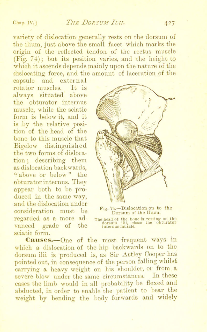 variety of dislocation generally rests on the dorsum of the ilivim, just above the small facet which marks the origin of the reflected tendon of the rectus muscle (Fig. 7-1:); but its position varies, and the height to which it ascends depends mainly upon the nature of the dislocating force, and the amount of lacei'ation of the capsule and external rotator muscles. It is always situated above the obturator internus muscle, while the sciatic form is below it, and it is by the relative posi- tion of the head of the bone to this muscle that Bigelow distinguished the two forms of disloca- tion ; describing them as dislocation backwards,  above or below  the obturator internus. They appear both to be pro- duced in the same way, and the dislocation under consideration must be regarded as a more ad- vanced grade of the sciatic form. Cause's.—One of the most frequent ways in which a dislocation of the hip backwai'ds on to the dorsum ilii is produced is, as Sir Astley Cooper has pointed out, in consequence of the person falling whilst carrving a heavy weight on his shoulder, or from a severe blow under the .same cii'cumstances. In these cases the lirnb would in all probability be flexed and abducted, in order to enable the patient to bear the weight by bending the body forwards and widely Fig. 74.—Dislocation on to the Dorsum of the Ilium. Tlie head of the heme is resting on the ilnrsuin ilii, ahuve the obturator iDterniis musclo.