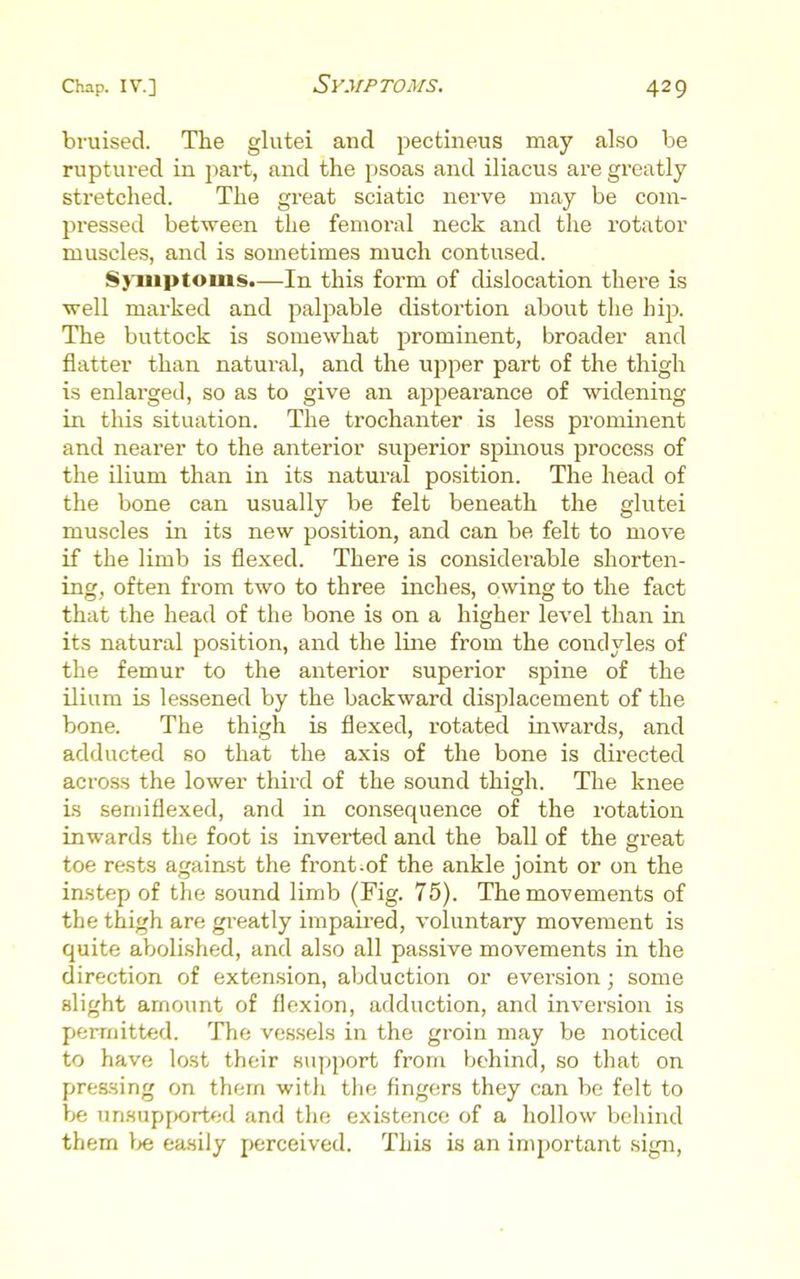 bruised. The glutei and pectineus may also be ruptured in part, and the psoas and iliacus are greatly stretched. The great sciatic nerve may be com- pressed between the femoral neck and the rotator muscles, and is sometimes much contused. S>uiptoms.—In this form of dislocation there is well marked and palpable distortion about the hip. The buttock is somewhat prominent, broader and flatter than natural, and the upper part of the thigh is enlarged, so as to give an appearance of widening in tliis situation. The trochanter is less prominent and nearer to the anterior superior spmous process of the ilium than in its natural position. The head of the bone can usually be felt beneath the glutei muscles in its new position, and can be felt to move if the limb is flexed. There is considerable shorten- ing, often from two to three inches, owing to the fact that the head of the bone is on a higher level than in its natural position, and the line from the condyles of the femur to the anterior superior spine of the ilium is lessened by the backward displacement of the bone. The thigh is flexed, rotated inwards, and adducted so that the axis of the bone is directed across the lower third of the sound thigh. The knee is semiflexed, and in consequence of the rotation inwards the foot is inverted and the ball of the great toe rests again.st the front.of the ankle joint or on the instep of the sound limb (Fig. 75). The movements of the thigh are greatly impaired, voluntary movement is quite abolished, and also all passive movements in the direction of extension, abduction or eversion; some slight amount of flexion, adduction, and inversion is permitted. The vessels in the groin may be noticed to have lost their support from behind, so that on pressing on them with the fingers they can be felt to be unsup[)0rted and the existence of a hollow behind them Ije easily perceived. This is an important sign.