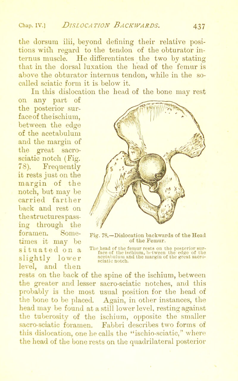 Chap. IV.) Dislocation Backjvards. the dorsum ilii, beyond defining their relative posi- tions witli regard to the tendon of the obturator in- ternus muscle. He differentiates the two by stating that in the dorsal luxation the head of the femur is above the obturator internus tendon, while in the so- called sciatic form it is below it. In this dislocation the head of the bone may rest on any part of the posterior sur- faceof theischium, between the edge of the acetabulum and the margin of Fig. the great sacro- sciatic notch (Fig. 78). Frequently it rests just on the margin of the notch, but may be carried farther back and rest on thestructui-es pass- ing through the foramen. Some- times it may be situated on a slightly lower level, and then rests on the back of the spine of the ischium, between the greater and lesser sacro-sciatic notches, and tliis probably is the most usual position for the head of the bone to be placed. Again, in other instances, the head may be found at a still lower level, resting against the tuberosity of the ischium, o})posite the smaller sacro-.sciatic foramen. Fabbri describes two forms of this dislocation, one he calls tlie ischio-sciatic, where the head of the bone rests on the quadrilateral posterior '8.—Dislocation backwards of the Head of the Femur. The head of the femur rests on the posterior sur- face of the i.*chiuiu, brtween the eiifrc of the acetaiiuluiu and the luargiu of the great sacro- sciatic notch.