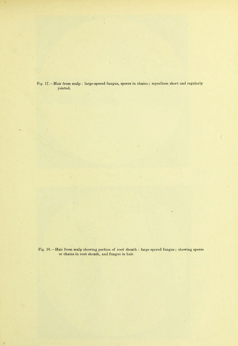 Fig. 17.—Hair from scalp : large-spored fungus, spores in chains ; mycelium short and regularly jointed. Fig. 18.—Hair from scalp showing portion of root sheath : large-spored fungus ; showing spores or chains in root sheath, and fungus in hair.