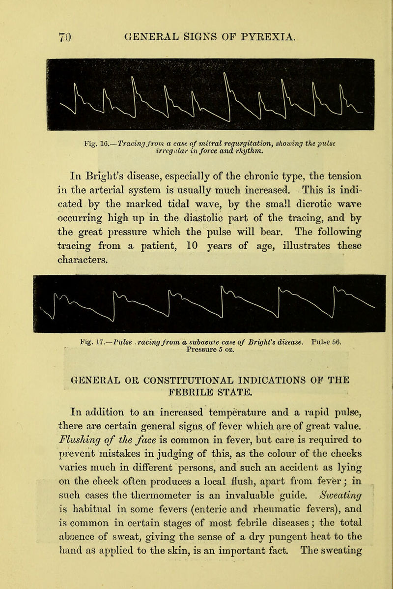 Fig. 16.—Tracing from a case of mitral regurgitation, showing the -pulse irregular in force and rhythm. In Bright's disease, especially of the chronic type, the tension in the arterial system is usually much increased. This is indi- cated by the marked tidal wave, by the small dicrotic wave occurring high up in the diastolic part of the tracing, and by the great pressure which the pulse will bear. The following tracing from a patient, 10 years of age, illustrates these characters. Fig. 17.—Pulse .racing from a subacute ca.«c of Bright's disease. Pulse 56. Pressure 5 oz. GENERAL OH CONSTITUTIONAL INDICATIONS OF THE FEBRILE STATE. In addition to an increased temperature and a rapid pulse, there are certain general signs of fever which are of great value. Flushing of the face is common in fever, but care is required to prevent mistakes in judging of this, as the colour of the cheeks varies much in different persons, and such an accident as lying on the cheek often produces a local flush, apart from fever ; in such cases the thermometer is an invaluable guide. Sweating is habitual in some fevers (enteric and rheumatic fevers), and is common in certain stages of most febrile diseases; the total absence of sweat, giving the sense of a dry pungent heat to the hand as applied to the skin, is an important fact. The sweating