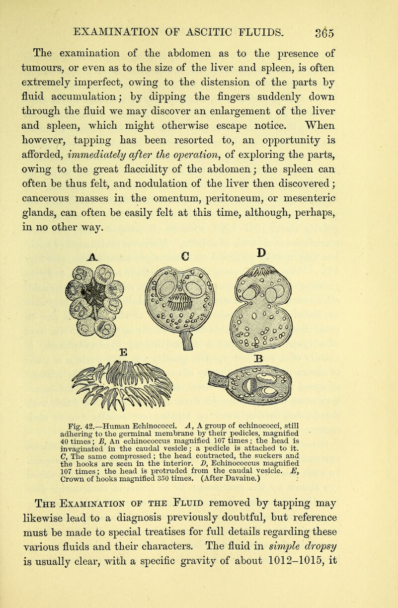 The examination of the abdomen as to the presence of tumours, or even as to the size of the liver and spleen, is often extremely imperfect, owing to the distension of the parts by fluid accumulation; by dipping the fingers suddenly down through the fluid we may discover an enlargement of the liver and spleen, which might otherwise escape notice. When however, tapping has been resorted to, an opportunity is afforded, immediately after the operation, of exploring the parts, owing to the great flaccidity of the abdomen; the spleen can often be thus felt, and nodulation of the liver then discovered; cancerous masses in the omentum, peritoneum, or mesenteric glands, can often be easily felt at this time, although, perhaps, in no other way. Fig. 42.—Human Echinococci. A, A group of echinococci, still adhering to the germinal membrane by their pedicles, magnified 40 times; B, A.n echinococcus magnified 107 times; the head is invaginated in the caudal vesicle ; a pedicle is attached to it. C, The same compressed; the head contracted, the suckers and the hooks are seen in the interior. D, Echinococcus magnified 107 times; the head is protruded from the caudal vesicle. E, Crown of hooks magnified 350 times. (After Davaine.) The Examination of the Fluid removed by tapping may likewise lead to a diagnosis previously doubtful, but reference must be made to special treatises for full details regarding these various fluids and their characters. The fluid in simple dropsy is usually clear, with a specific gravity of about 1012-1015, it C D