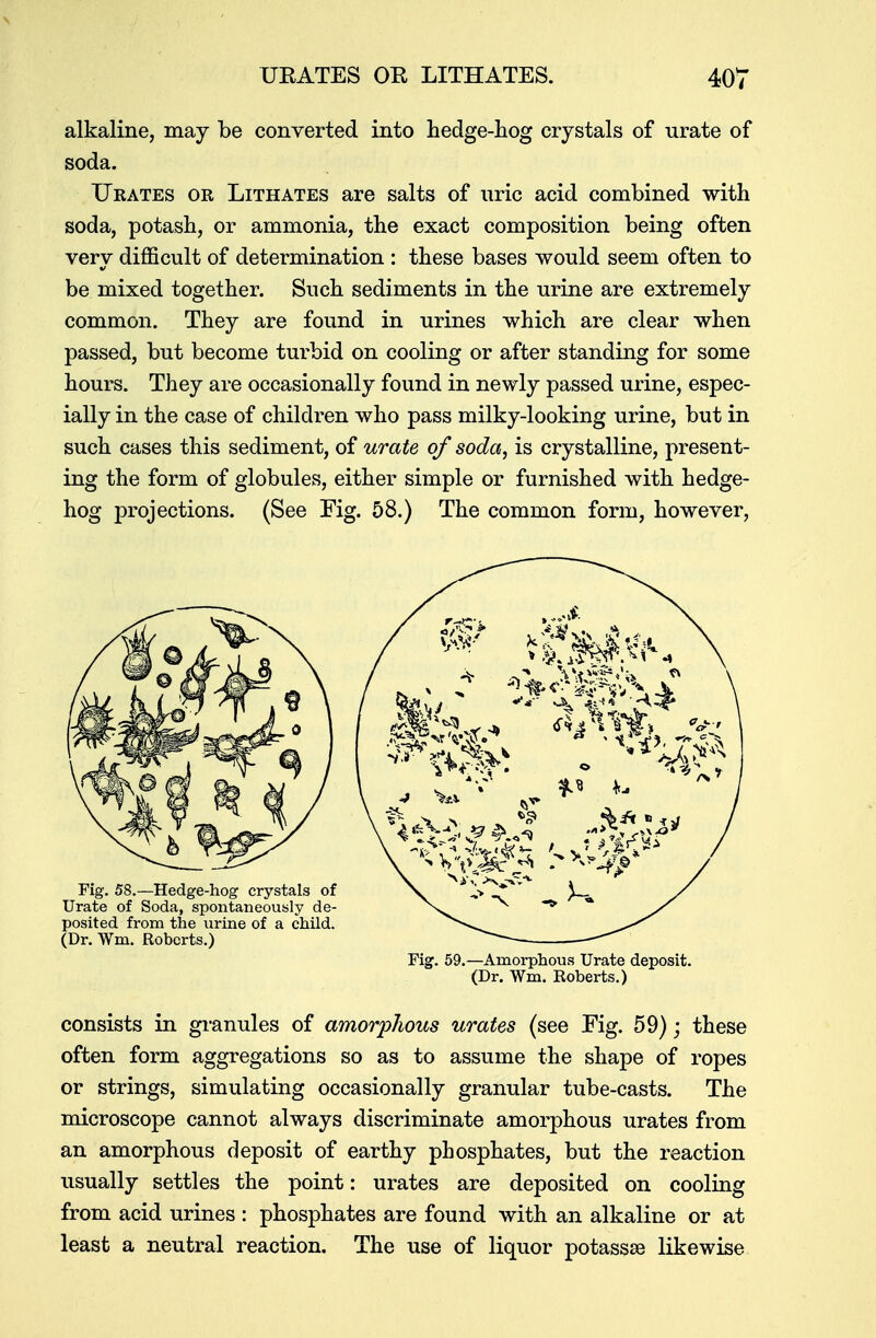 alkaline, may be converted into hedge-hog crystals of urate of soda. Urates or Lithates are salts of uric acid combined with soda, potash, or ammonia, the exact composition being often very difficult of determination : these bases would seem often to be mixed together. Such sediments in the urine are extremely common. They are found in urines which are clear when passed, but become turbid on cooling or after standing for some hours. They are occasionally found in newly passed urine, espec- ially in the case of children who pass milky-looking urine, but in such cases this sediment, of urate of soda, is crystalline, present- ing the form of globules, either simple or furnished with hedge- hog projections. (See Fig. 58.) The common form, however, Fig. 59.—Amorphous Urate deposit. (Dr. Wm. Roberts.) consists in granules of amorphous urates (see Fig. 59); these often form aggregations so as to assume the shape of ropes or strings, simulating occasionally granular tube-casts. The microscope cannot always discriminate amorphous urates from an amorphous deposit of earthy phosphates, but the reaction usually settles the point: urates are deposited on cooling from acid urines : phosphates are found with an alkaline or at least a neutral reaction. The use of liquor potassse likewise