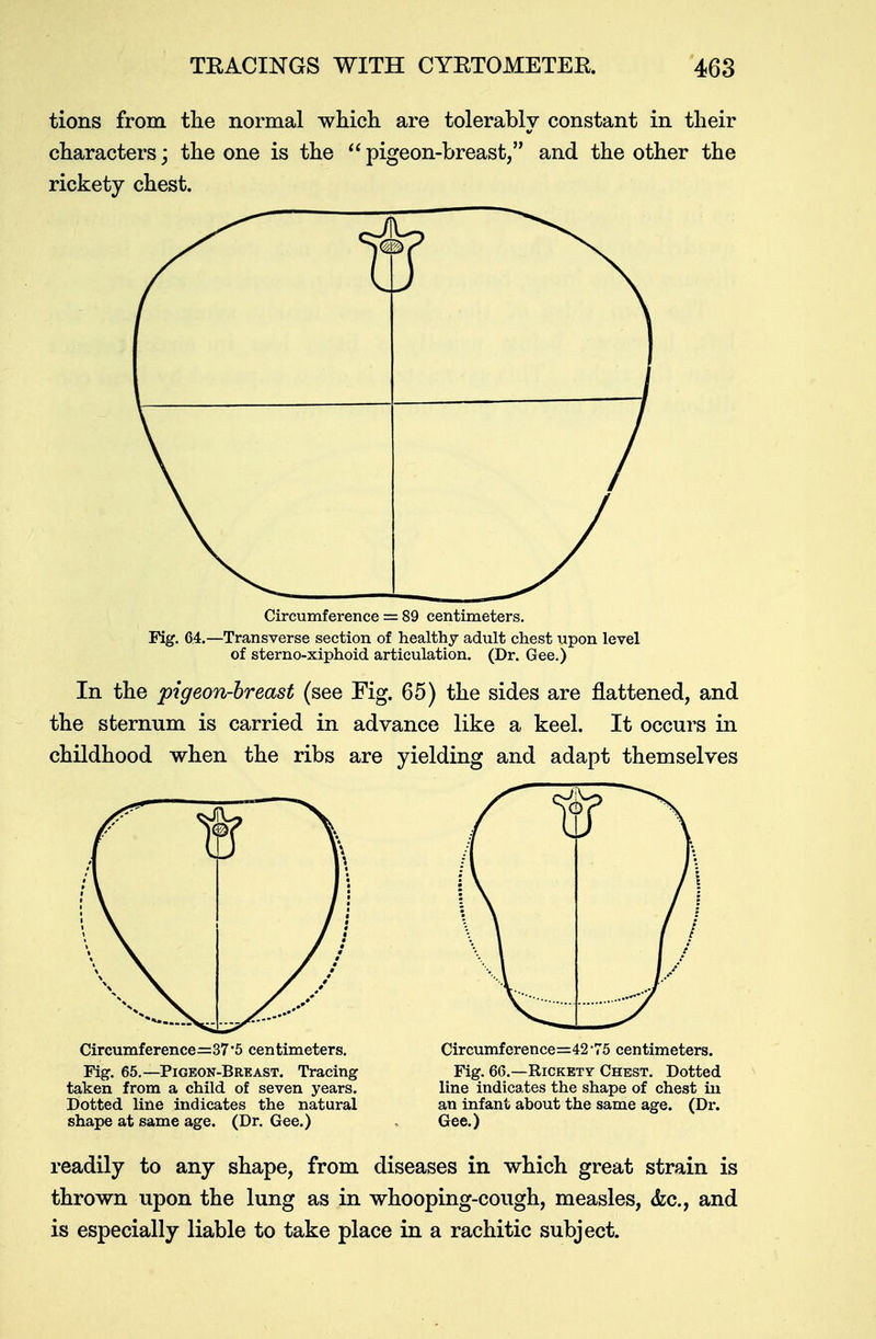 tions from the normal which are tolerably constant in their characters; the one is the  pigeon-breast, and the other the rickety chest. Circumference = 89 centimeters. Fig. 6.4.—Transverse section of healthy adult chest upon level of sterno-xiphoid articulation. (Dr. Gee.) In the pigeon-breast (see Fig. 65) the sides are flattened, and the sternum is carried in advance like a keel. It occurs in childhood when the ribs are yielding and adapt themselves Circumference=37'5 centimeters. Circumference=42-75 centimeters. Fig. 65.—Pigeon-Breast. Tracing Fig. 66.—Rickety Chest. Dotted taken from a child of seven years. line indicates the shape of chest in Dotted line indicates the natural an infant about the same age. (Dr. shape at same age. (Dr. Gee.) , Gee.) readily to any shape, from diseases in which great strain is thrown upon the lung as in whooping-cough, measles, &c, and is especially liable to take place in a rachitic subject.