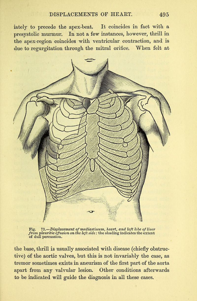 iately to precede the apex-beat. It coincides in fact with a presystolic murmur. In not a few instances, however, thrill in the apex-region coincides with ventricular contraction, and is due to regurgitation through the mitral orifice. When felt at Fig. 73.—Displacement of mediastinum, heart, and left lobe of liver from pleuritic effusion on the left side: the shading indicates the extent of dull percussion. the base, thrill is usually associated with disease (chiefly obstruc- tive) of the aortic valves, but this is not invariably the case, as tremor sometimes exists in aneurism of the first part of the aorta apart from any valvular lesion. Other conditions afterwards to be indicated will guide the diagnosis in all these cases.