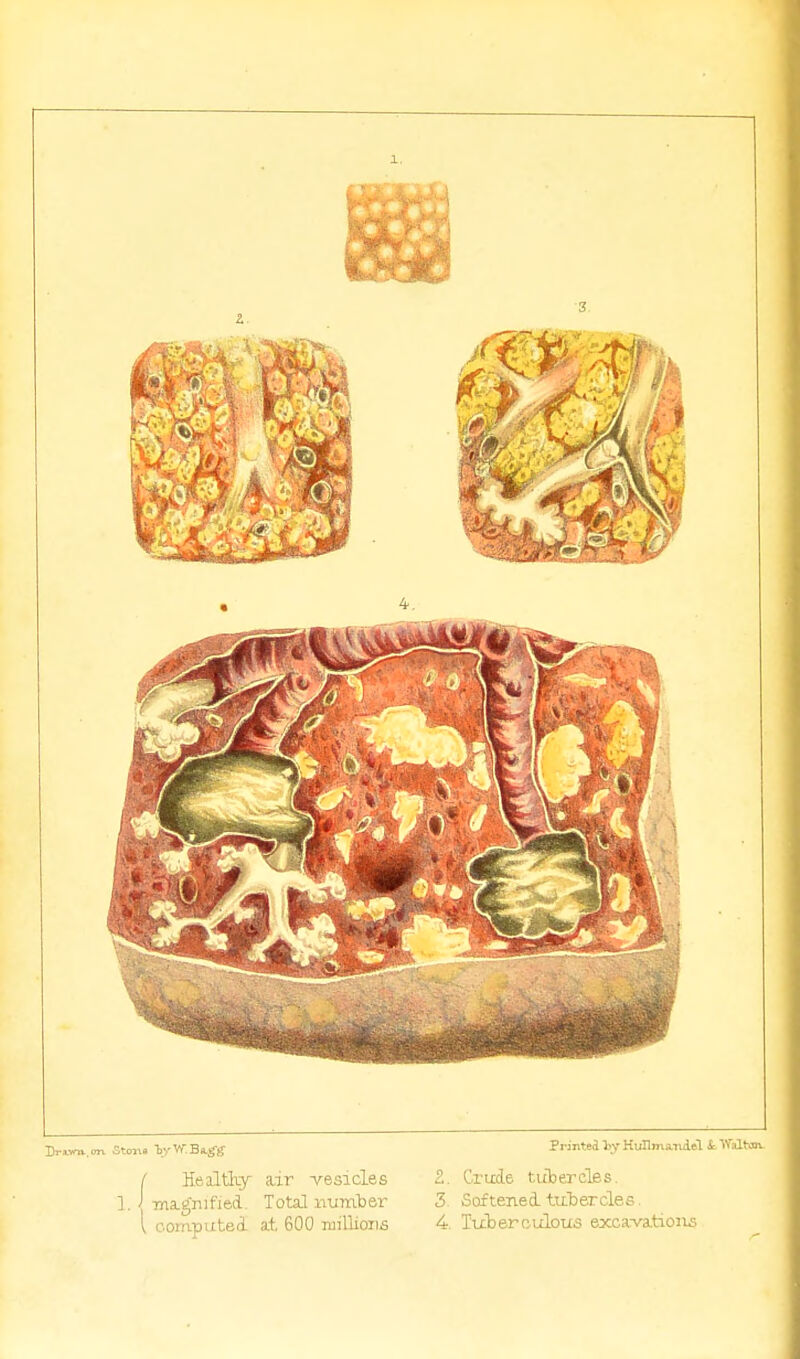 I : : ( Healtliy a,ir -vesicles 1. Tna-gnified. Total numter \ computed a.t 600 raillions Printed ty Hullma-mlel t tValtoi 2. Crude tubercles. 3. Softened, tttbercles. 4 Tuberculous excarvutioii^