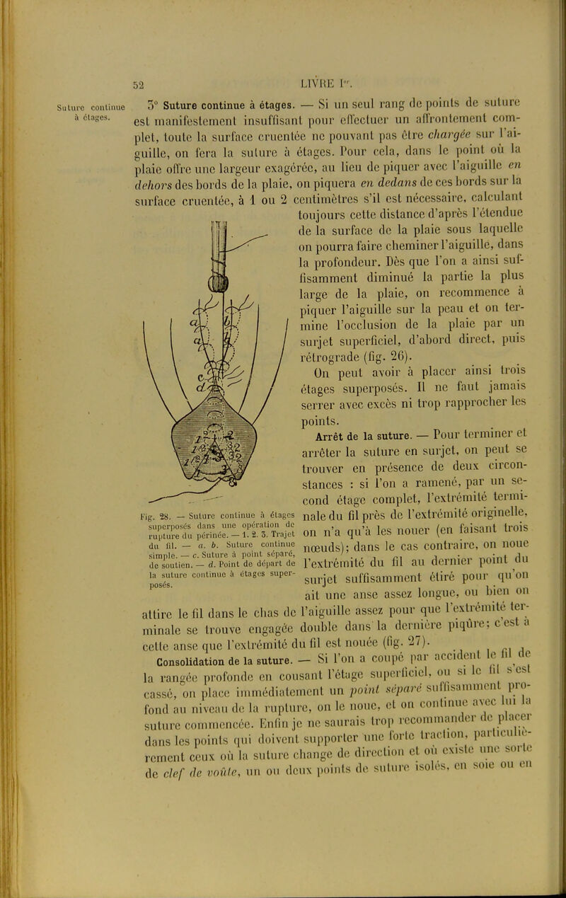 Sulurc continue à ctapres. 5° Suture continue à étages. — Si un seul rang do points de suture est manifestement insuffisant pour effectuer un affrontement com- plet, toute la surface crucntée ne pouvant pas être chargée sur l'ai- guille, on fera la suture à étages. Pour cela, dans le point où la plaie offre une largeur exagérée, au lieu de piquer avec l'aiguille en dehors des bords de la plaie, on piquera en dedans de ces bords sur la surface cruentée, à 1 ou 2 centimètres s'il est nécessaire, calculant toujours cette distance d'après l'étendue de la surface de la plaie sous laquelle on pourra faire cheminer l'aiguille, dans la profondeur. Dès que l'on a ainsi suf- fisamment diminué la partie la plus large de la plaie, on recommence à piquer l'aiguille sur la peau et on ter- mine l'occlusion de la plaie par un surjet superficiel, d'abord direct, puis rétrograde (fig. 26). On peut avoir à placer ainsi trois étages superposés. Il ne faut jamais serrer avec excès ni trop rapprocher les points. Arrêt de la suture. — Pour terminer et arrêter la suture en surjet, on peut se trouver en présence de deux circon- stances : si l'on a ramené, par un se- cond étage complet, l'extrémité termi- Fig. 28. - suture continue à étages nale du fil près de l'extrémité originelle, 7Sltt^t^ on n'a qu'à les nouer (en faisant trois du m. — a. b. suture continue nœu{js). dans le cas contraire, on noue simple. — c. Suture à point séparé, «. , -, 'n( An de soutien. - d. Point de départ de l'extrémité du fil au dernier point du la suture continue à étages super- suffisamment étiré pour qu'on posés. 1311 J , . ait une anse assez longue, ou bien on attire le fil dans le chas de l'aiguille assez pour que l'extrémité ter- minale se trouve engagée double dans la dernière piqûre; c est a cette anse que l'extrémité du fil est nouée (fig. 27). Consolidation de la suture. - Si l'on a coupé par accidenl le W de la rangée profonde en cousant l'étage superficiel, ou s. le h s est cassé, on place immédiatement un point séparé suffisamment pro- fond au niveau de la rupture, on le noue, et on continue avec lui la suture commencée. Enfin je ne saurais trop recommander de placer dans les points qui doivent supporter un, forte traction particuliè- rement ceux où la suture change de direction et où existe une sorte de clef de voûte, un on deux points de suture isolés, en soie ou on :